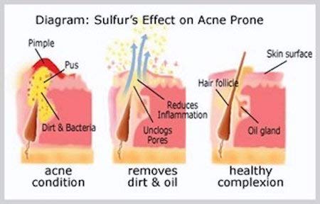 JOESOEF SKIN CARE Sulfur Soap Acne Facial Cleanser 4-Pack