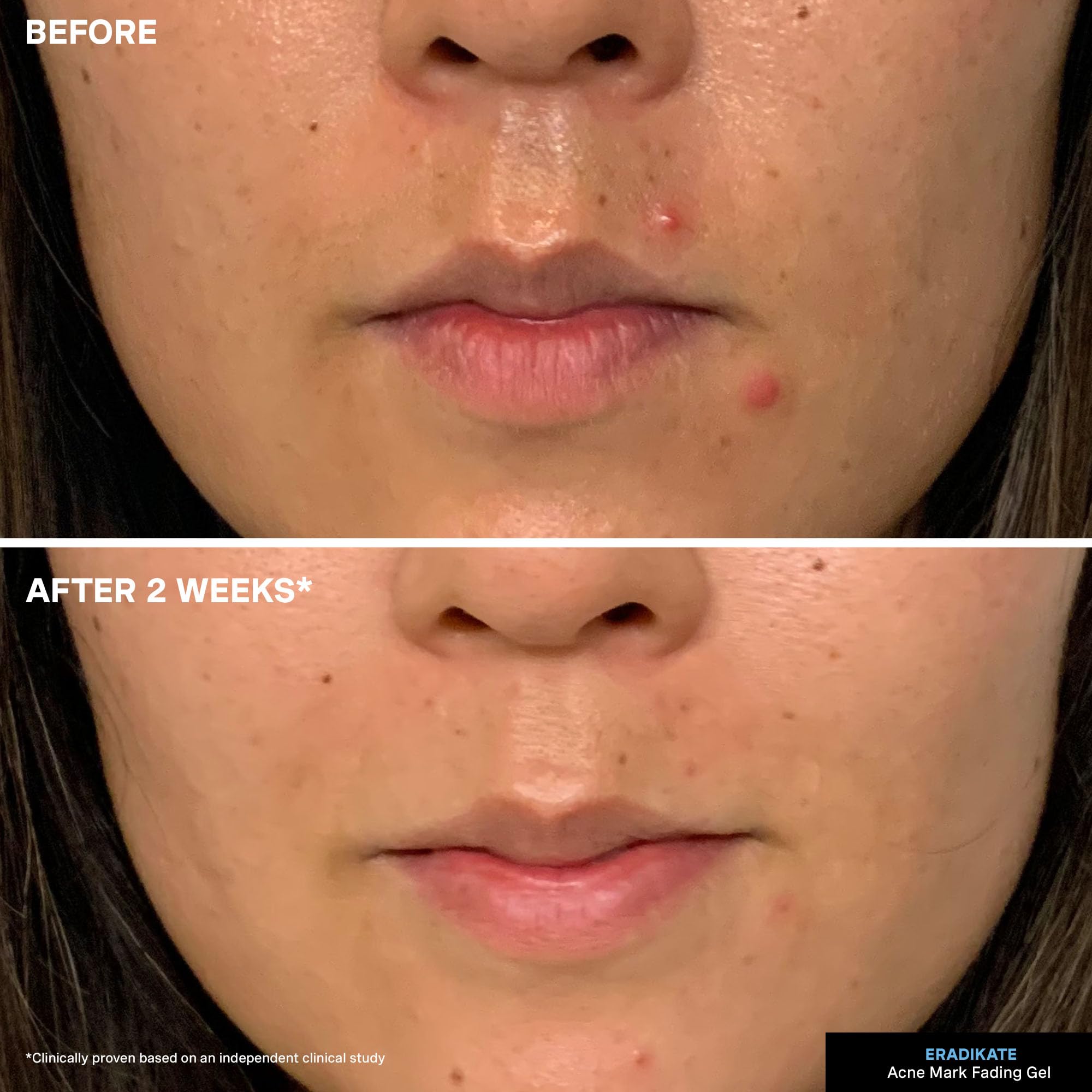 Kate Somerville EradiKate Acne Mark Fading Gel | Salicylic Acid Treatment | 1 oz