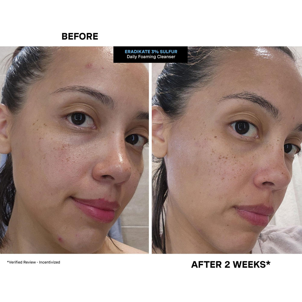 Kate Somerville EradiKate 3% Sulfur Daily Foaming Cleanser – Acne-Prone Skin, Pore Cleansing, 4 oz