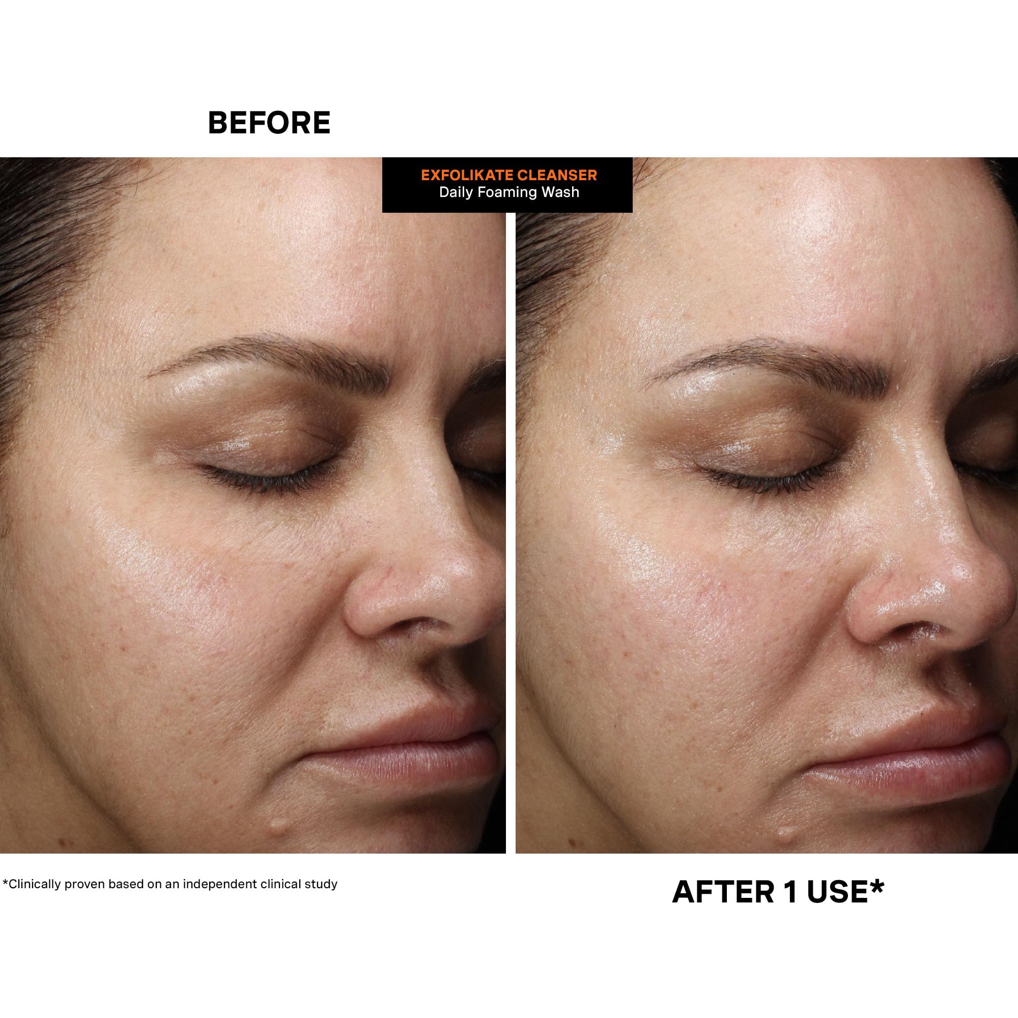Kate Somerville ExfoliKate Cleanser: Daily Exfoliating Foaming Face Wash with Glycolic & Lactic Acids (8 oz)