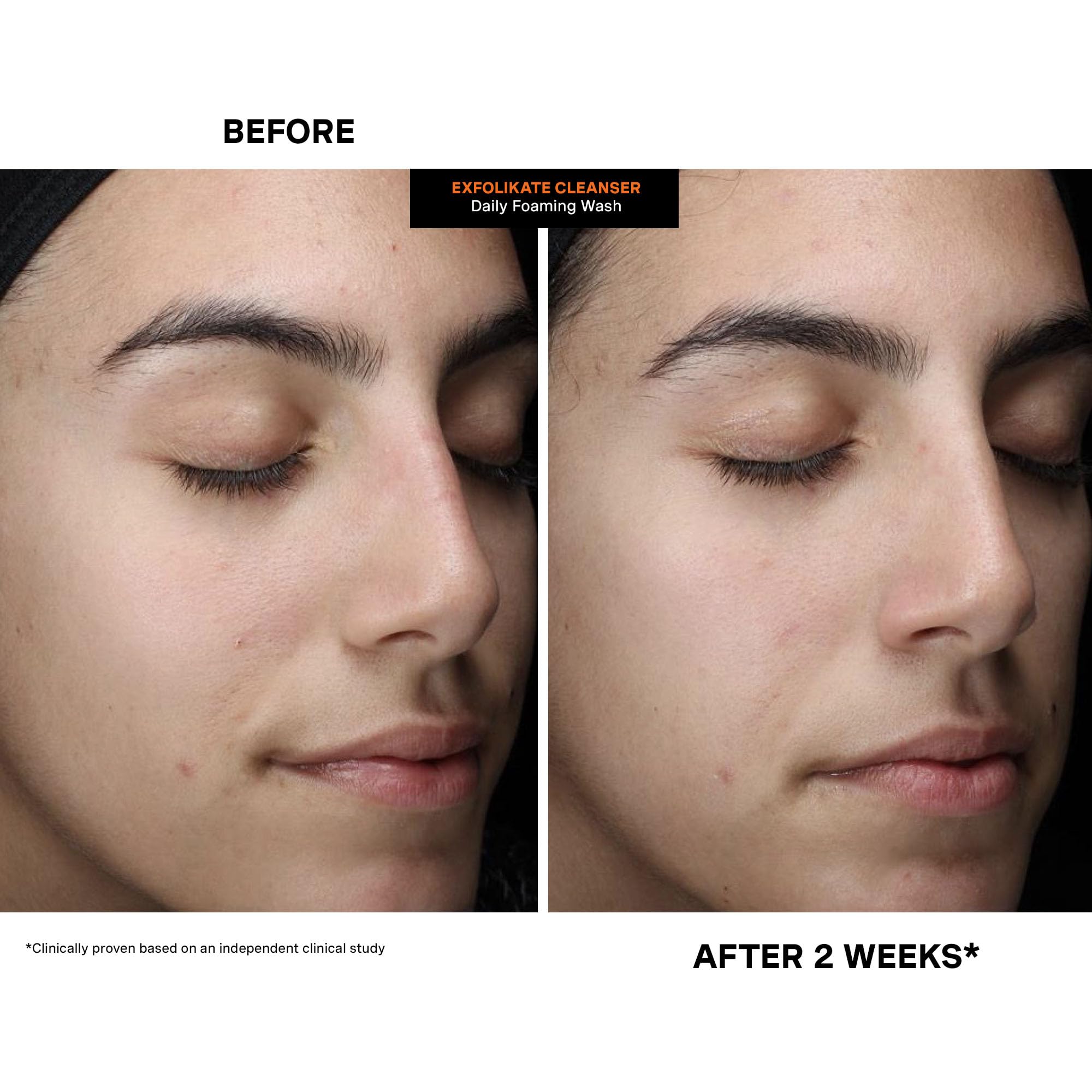 Kate Somerville ExfoliKate Cleanser: Daily Exfoliating Foaming Face Wash with Glycolic & Lactic Acids (8 oz)