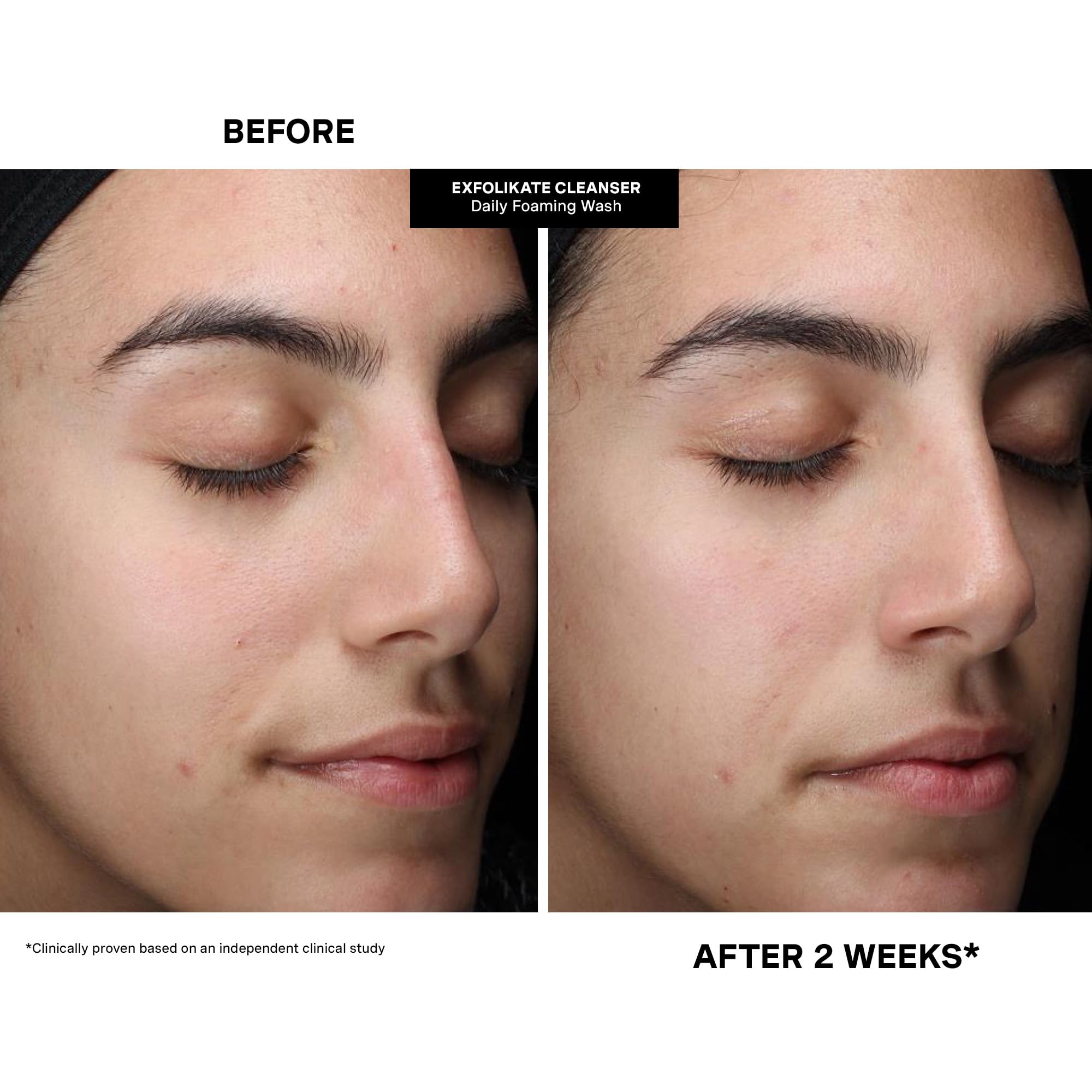 Kate Somerville Pore-fect Skin Edit Travel Kit: ExfoliKate, EradiKate & Goat Milk Cleanser