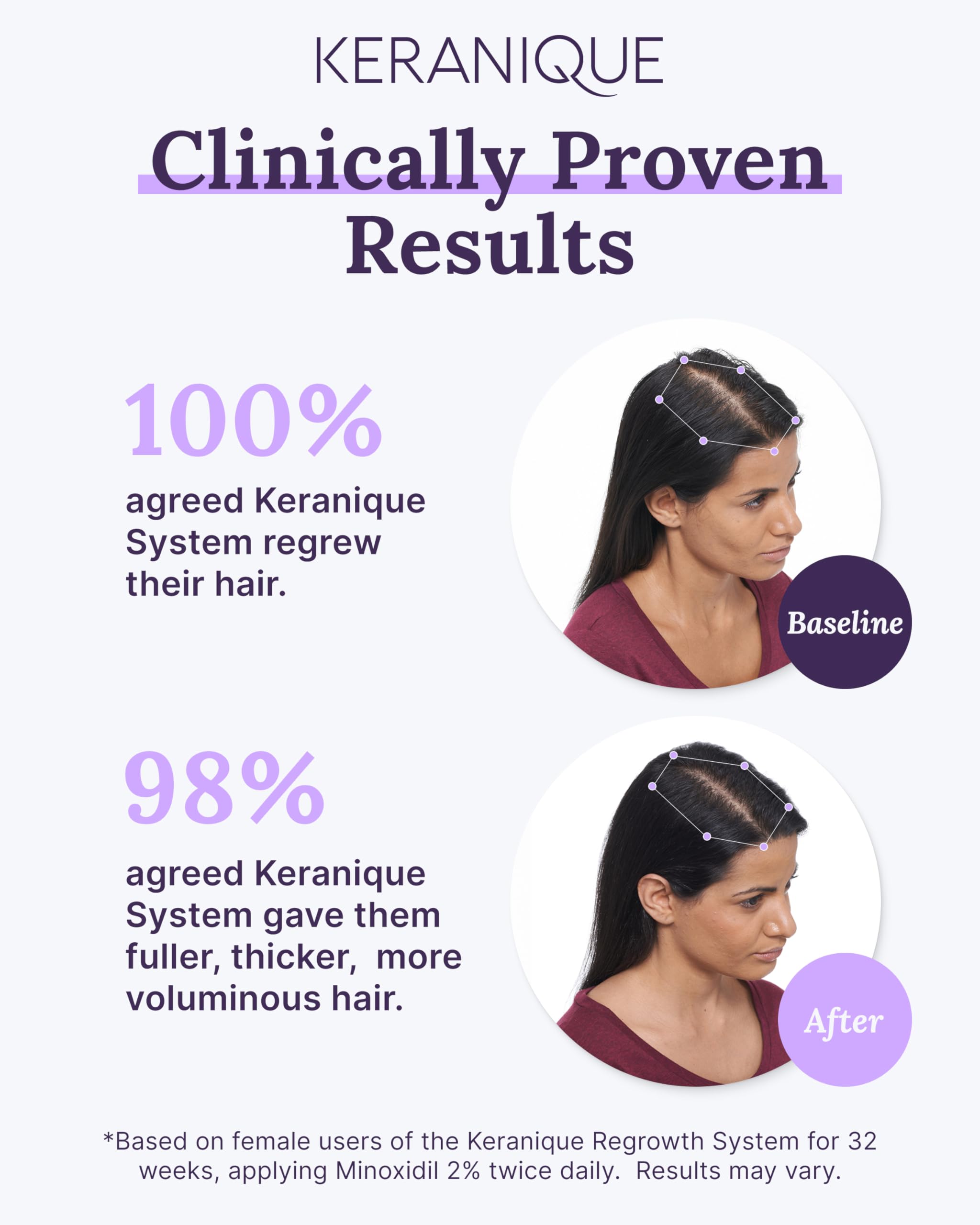 Keranique 5% Minoxidil Foam for Women – Hair Regrowth & Scalp Nourishment (2 Month Supply)