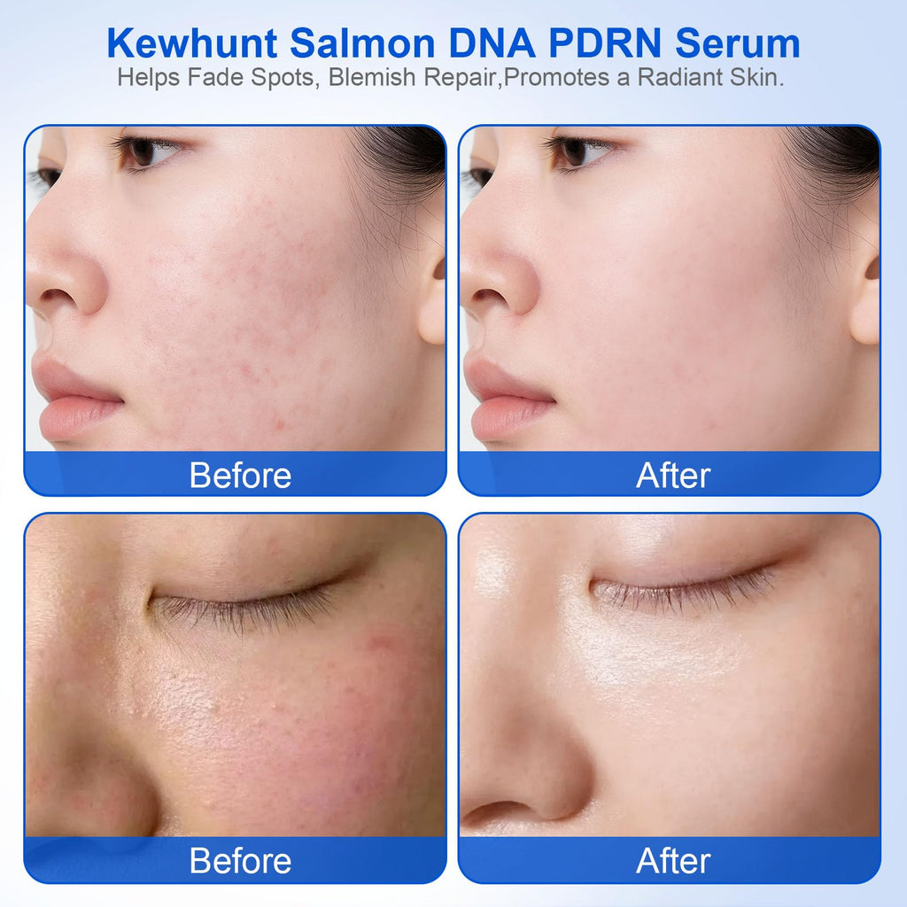 Kewhunt Salmon DNA PDRN Anti-Aging Serum – 10,000ppm PDRN, 3,000ppm Collagen, Peptides & Niacinamide