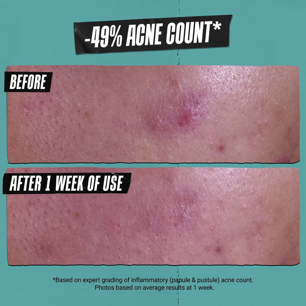 Kiehl's Acne-Treating Cleansing Paste – 3-in-1 Cleanser, Spot Treatment & Face Mask