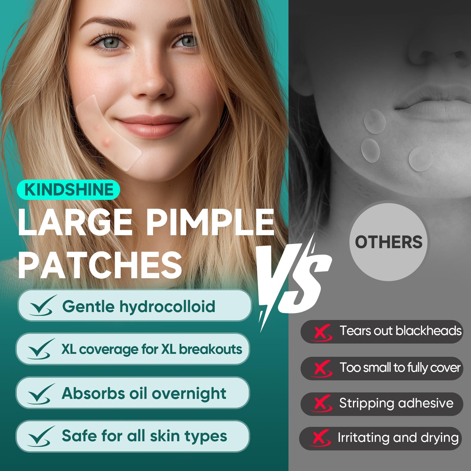 kindshine 96 Count XL Pimple Patches | Hydrocolloid Acne Patches for Face & Body – Vegan, Cruelty-Free