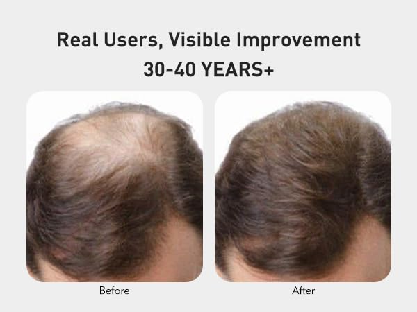 KINTOR 0.5% KX-826 Hair Regrowth Spray for Men – Plant-Based DHT Blocker, 60ml