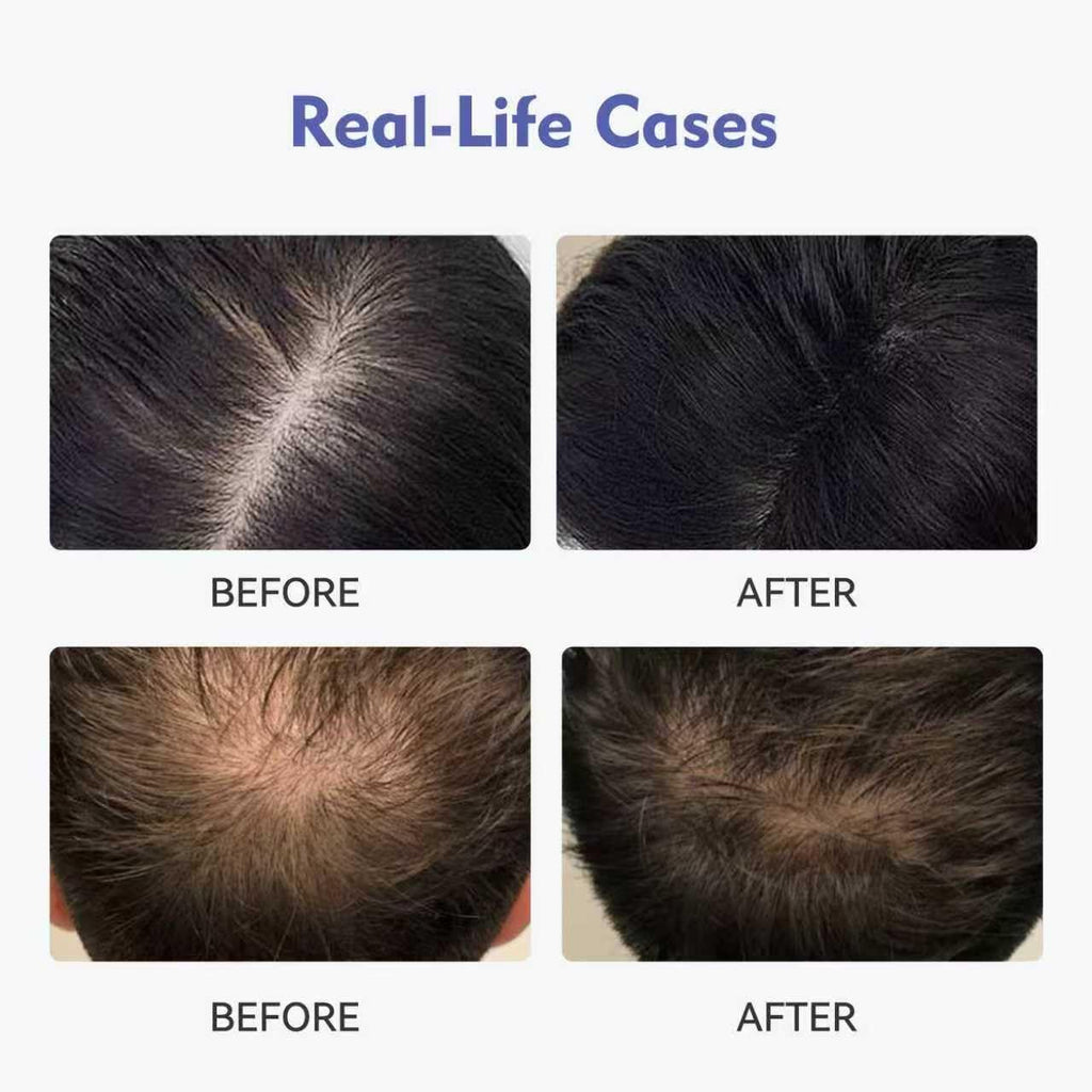 KINTOR 0.9% KX-826 DHT Blocker Hair Growth Foam 60ml Pro | For Men & Women