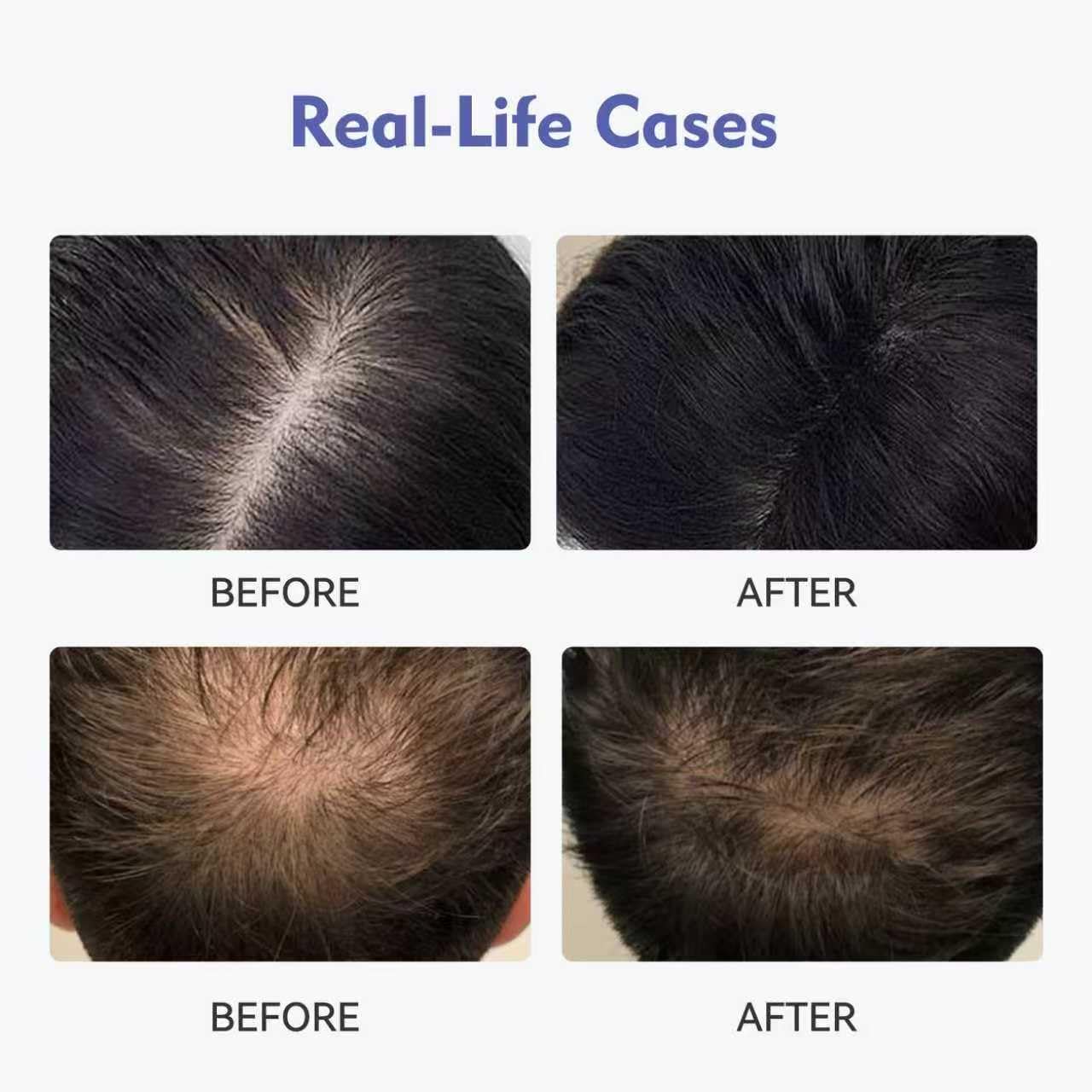 KINTOR 0.9% KX-826 DHT Blocker Hair Growth Foam 60ml Pro | For Men & Women