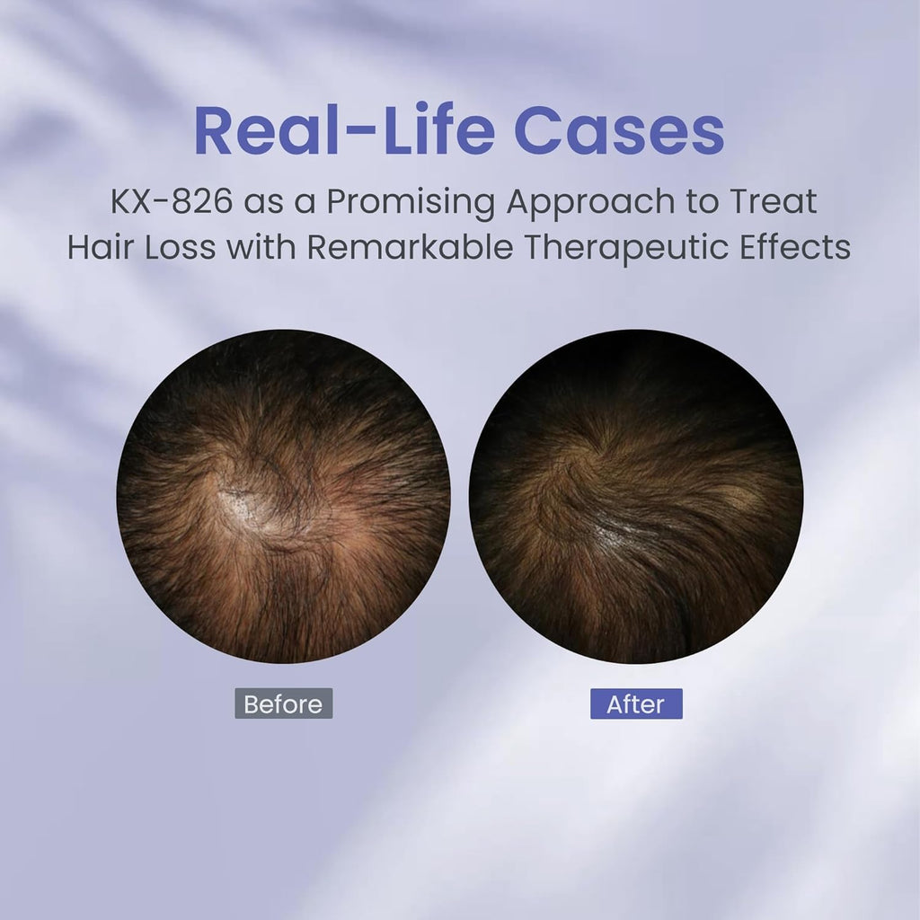 KINTOR 0.9% KX-826 Hair Regrowth Spray – Supports Healthy Hair Growth & Oil Control | 60ml