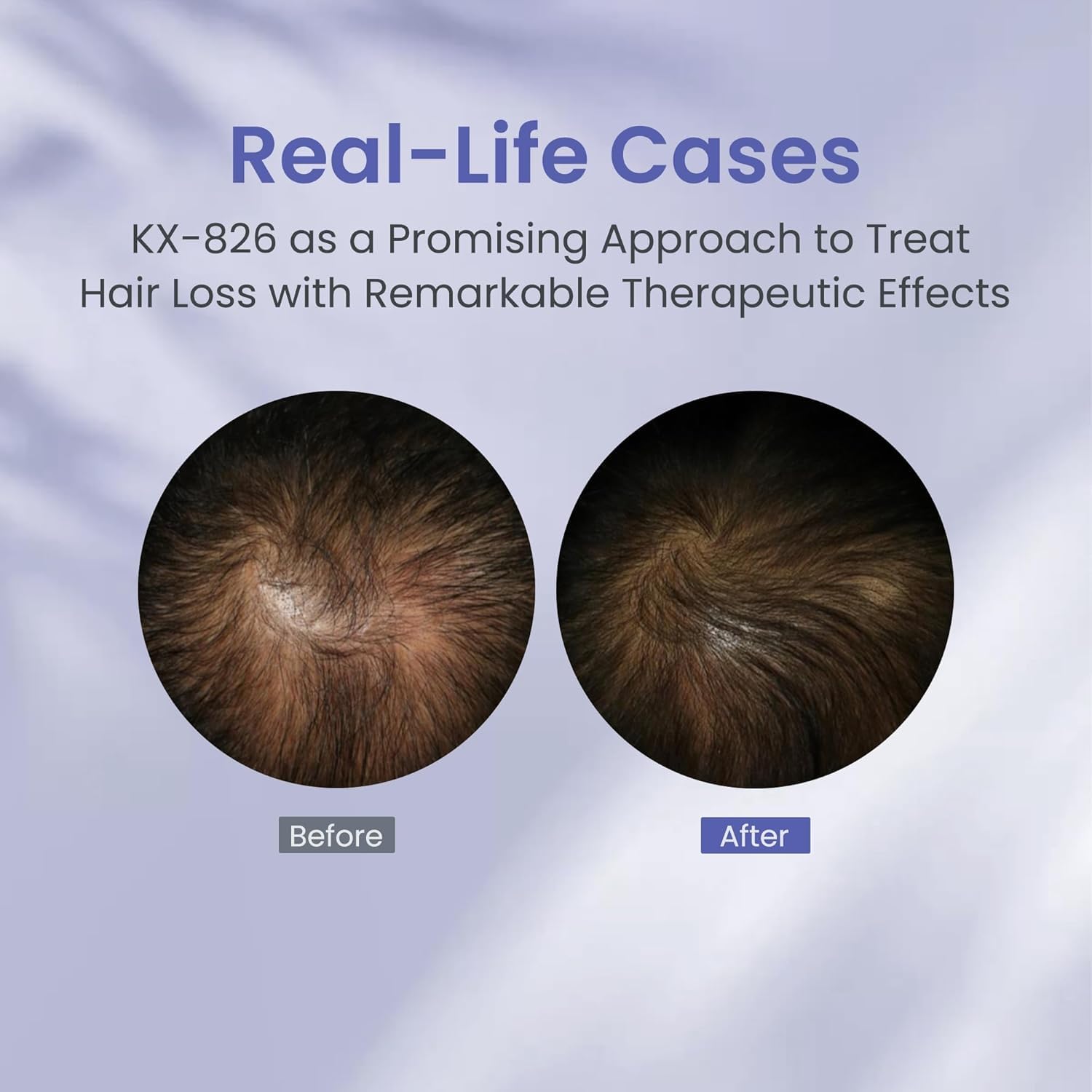 KINTOR 0.9% KX-826 Hair Regrowth Spray – Supports Healthy Hair Growth & Oil Control | 60ml