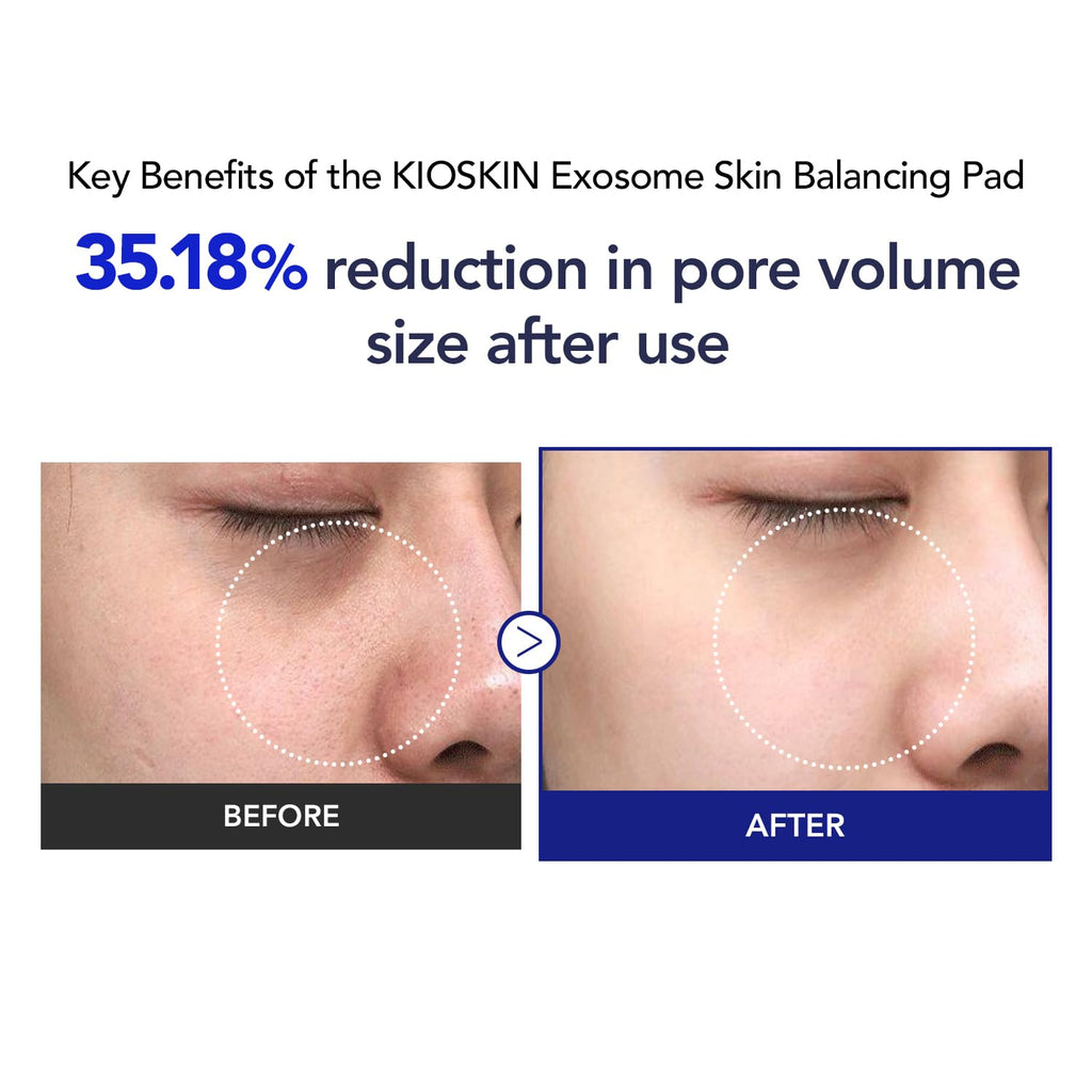 KIOSKIN Toner Pads – 35% Smaller Pores, 32% Reduced Pore Area, CICA Exosomes, AHA/BHA/PHA