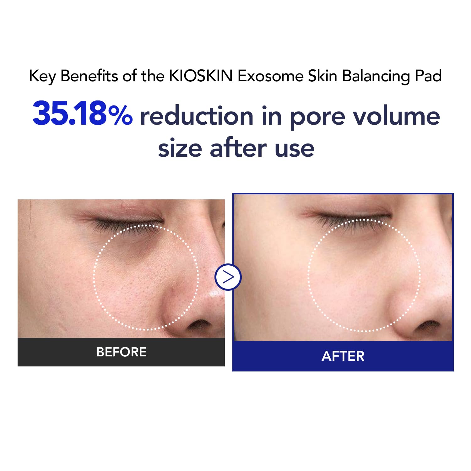 KIOSKIN Toner Pads – 35% Smaller Pores, 32% Reduced Pore Area, CICA Exosomes, AHA/BHA/PHA