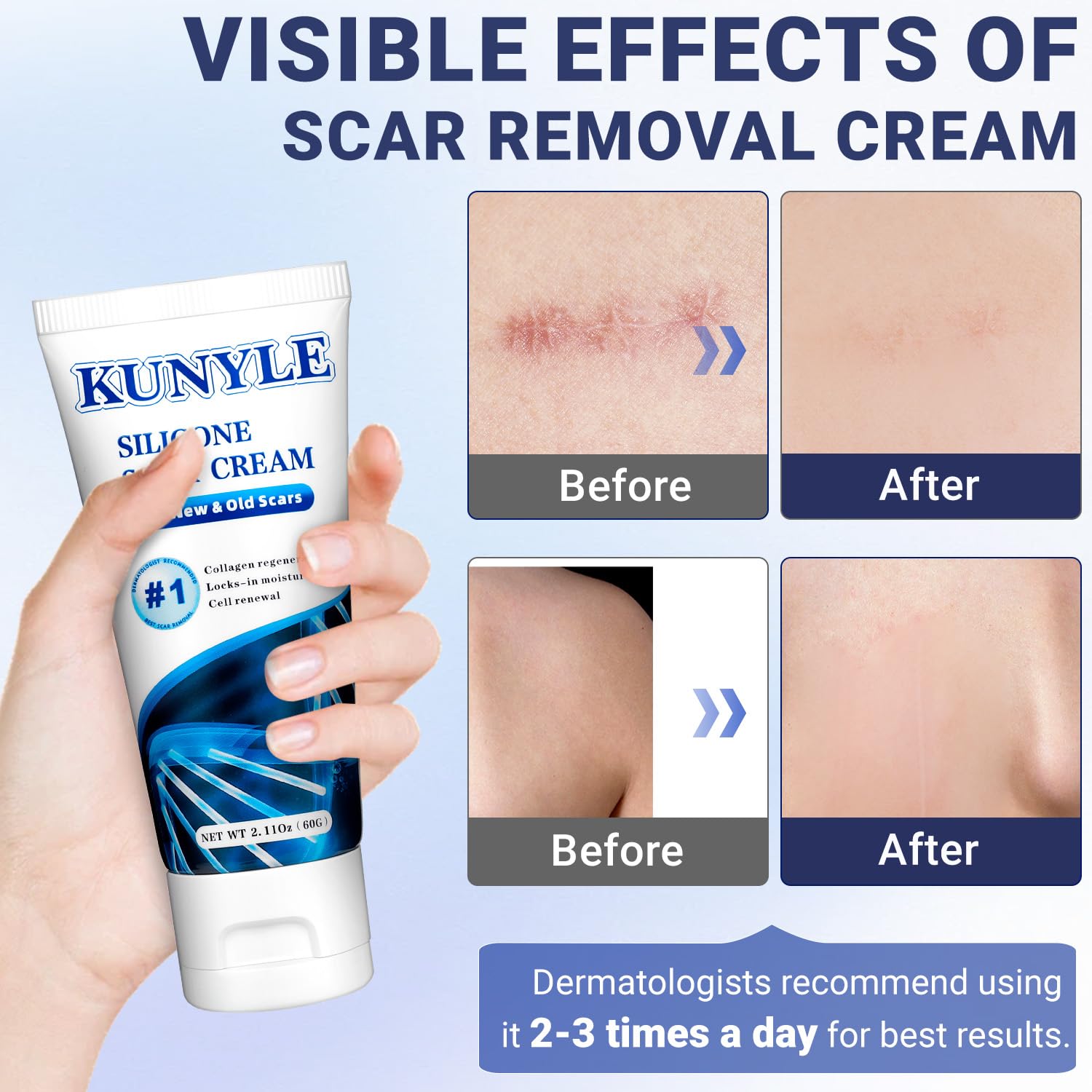 Kunyle Silicone Scar Cream - Advanced Scar Gel for Surgical Scars, Keloids, and Stretch Marks | 2.11 oz (60 g)