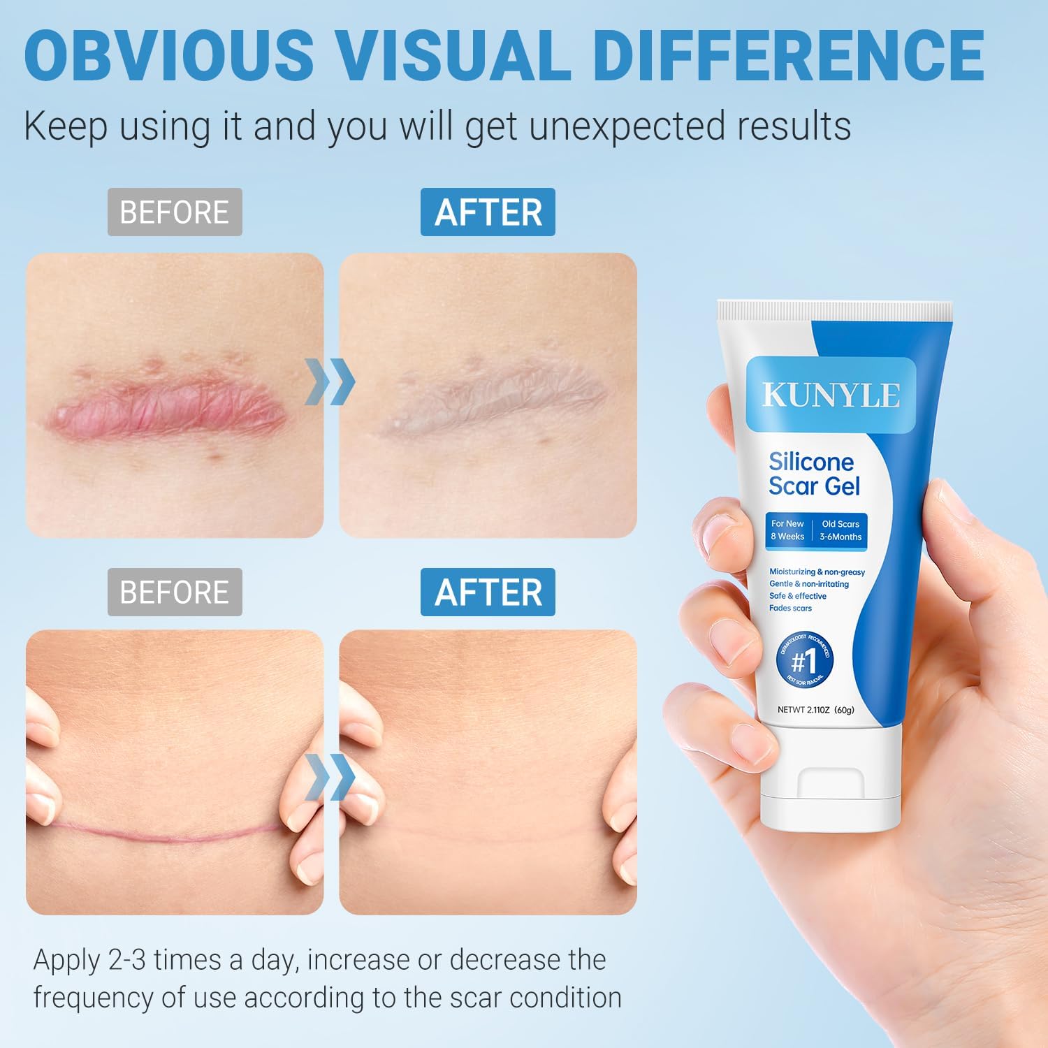 Kunyle Silicone Scar Gel – Advanced Scar Cream for Surgical Scars, Stretch Marks & Keloids | 2.11oz