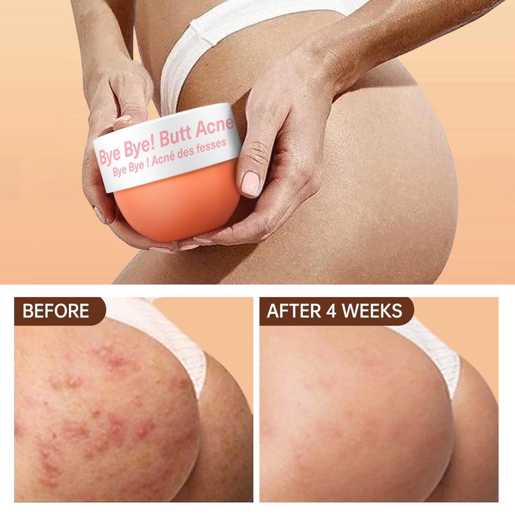 LA.PERSONAL Butt Acne Clearing Treatment – Body Cream for Back, Buttocks, Thigh & Chest