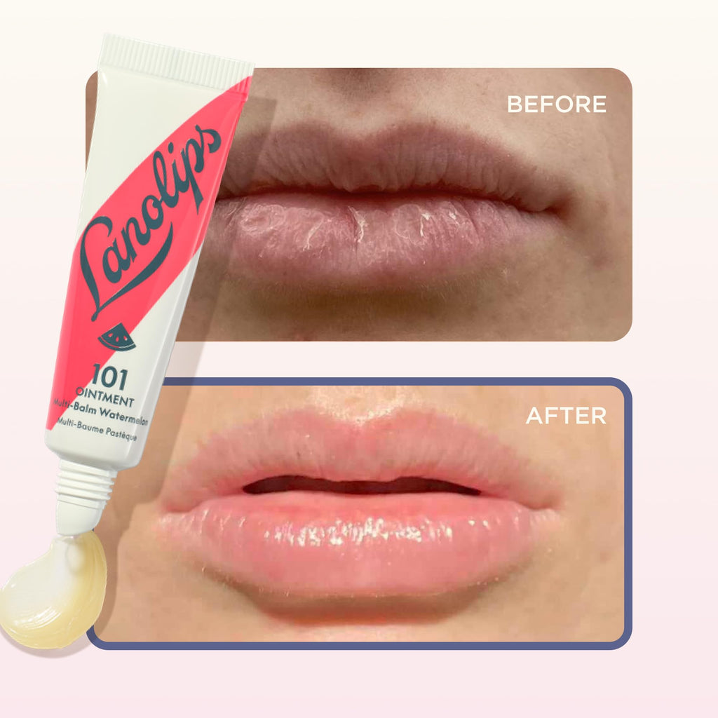 Lanolips 101 Ointment Watermelon Lip Balm – Hydrating Lanolin Ointment, 0.52 oz
