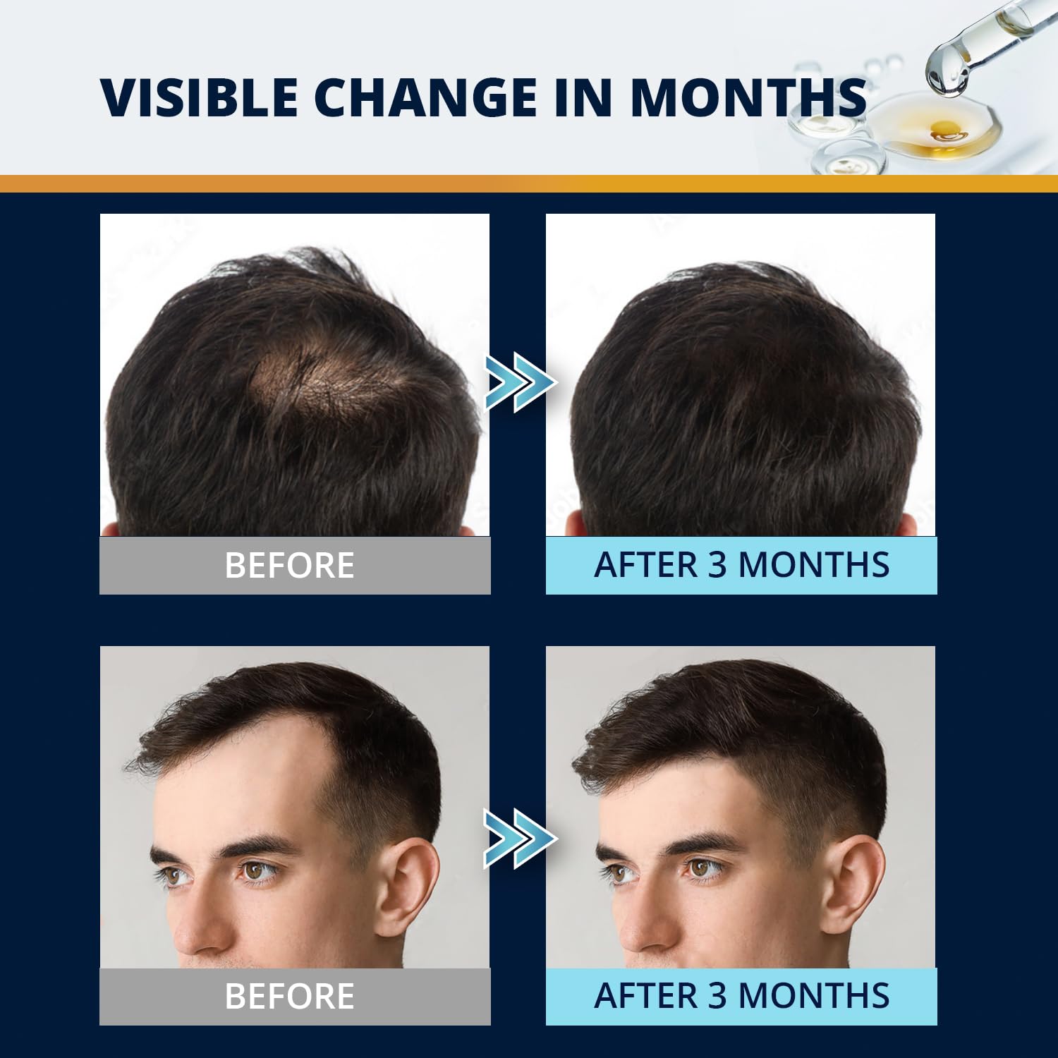 Lilivera 5% Minoxidil Hair & Beard Growth Kit – Extra Strength Topical Serum