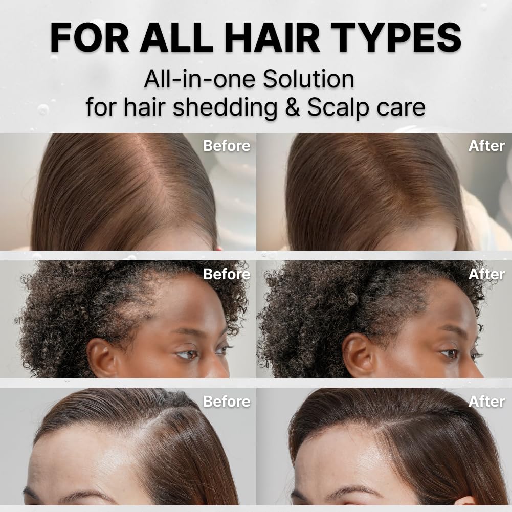 lilyeve GROWTURN Hair Growth Serum with Built-In Brush – Heartleaf Exosomes, Hair Thickening & Growth Support (Korean Hair Care) – 3.38 oz