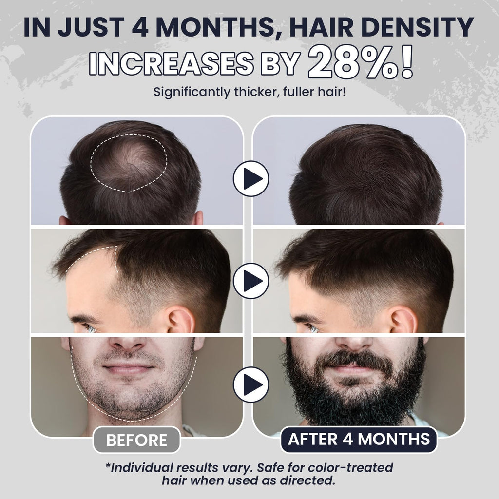 LIPEND 5% Minoxidil for Men Hair Growth Serum – 3x2oz bottles