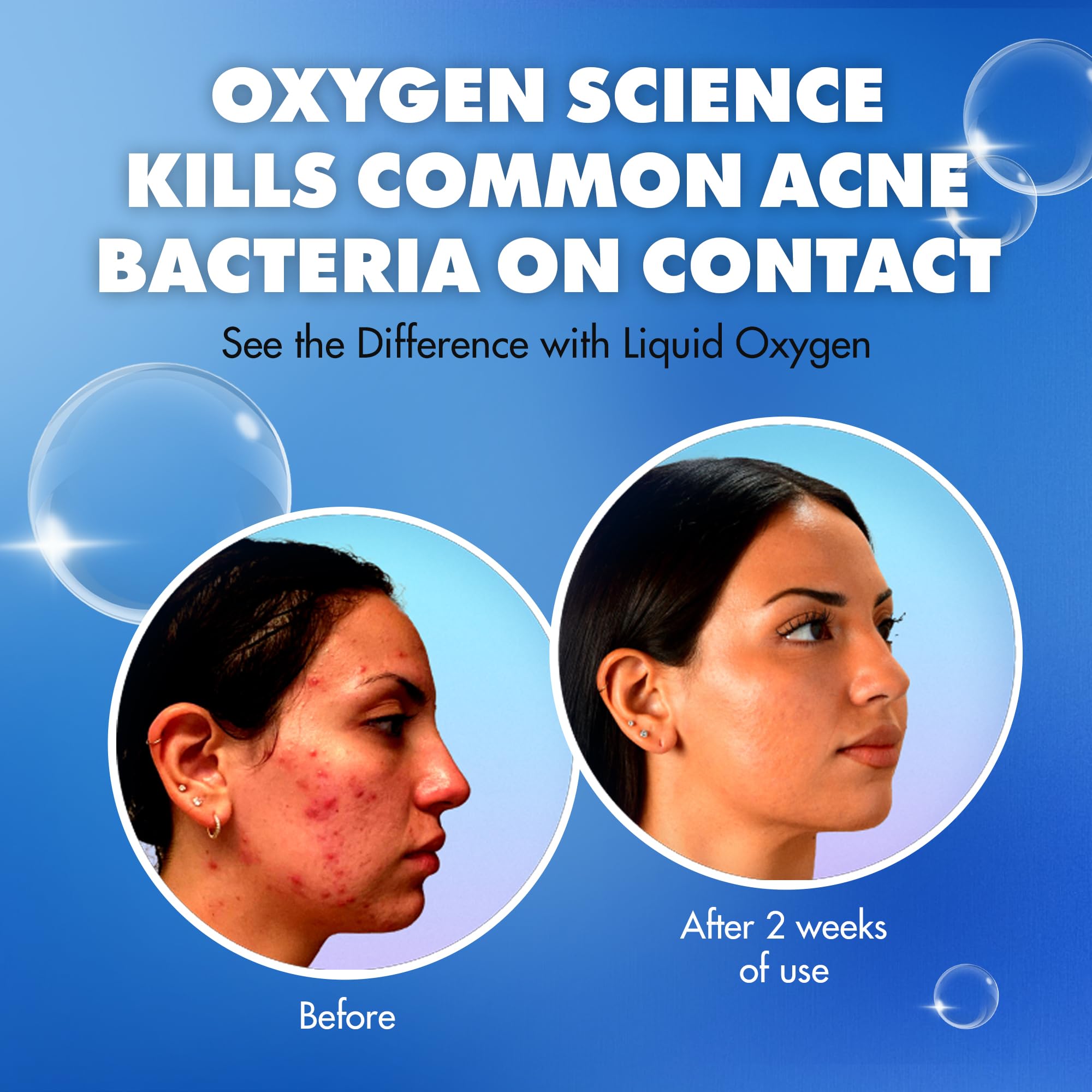 Liquid Oxygen Acne Treatment System for Clearer Skin | Oxygen-Infused 3-Step Kit (Wash, Toner & SPF 30 Moisturizer) | Dermatologist-Recommended