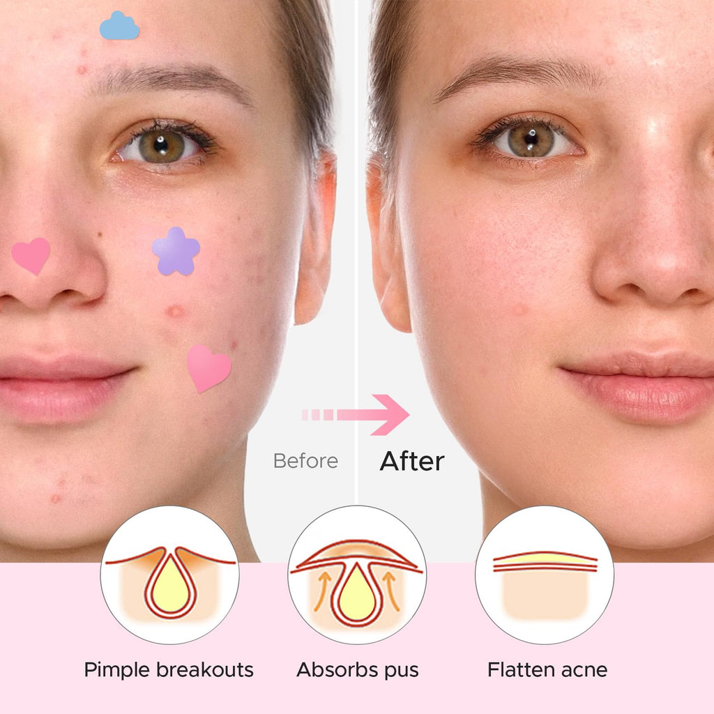 LitBear Acne Pimple Patch – 360 Dots, 3 Shapes, Salicylic Acid, Tea Tree & Calendula