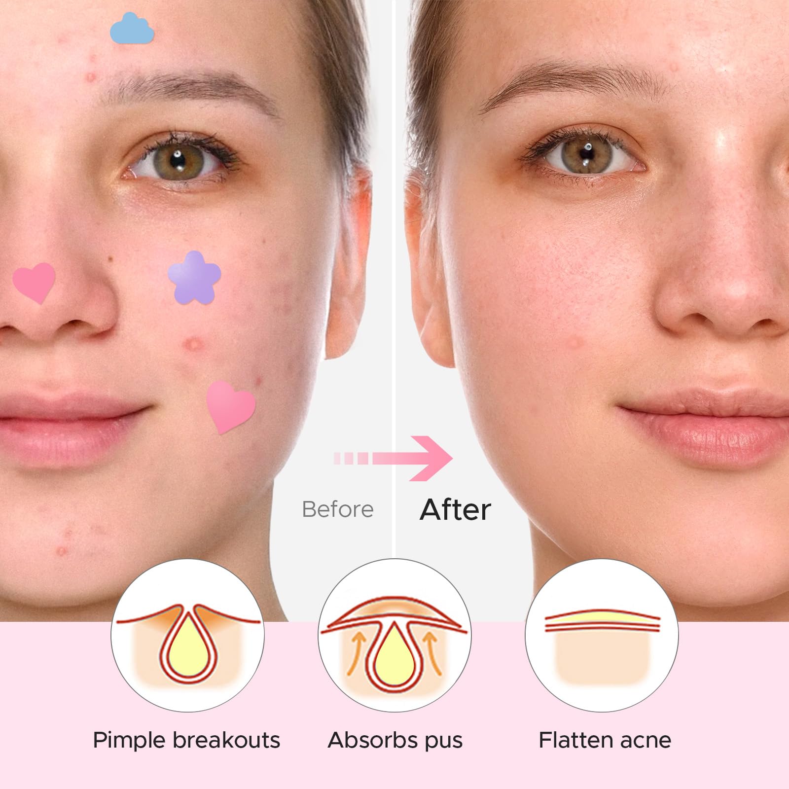 LitBear Acne Pimple Patch – 360 Dots, 3 Shapes, Salicylic Acid, Tea Tree & Calendula