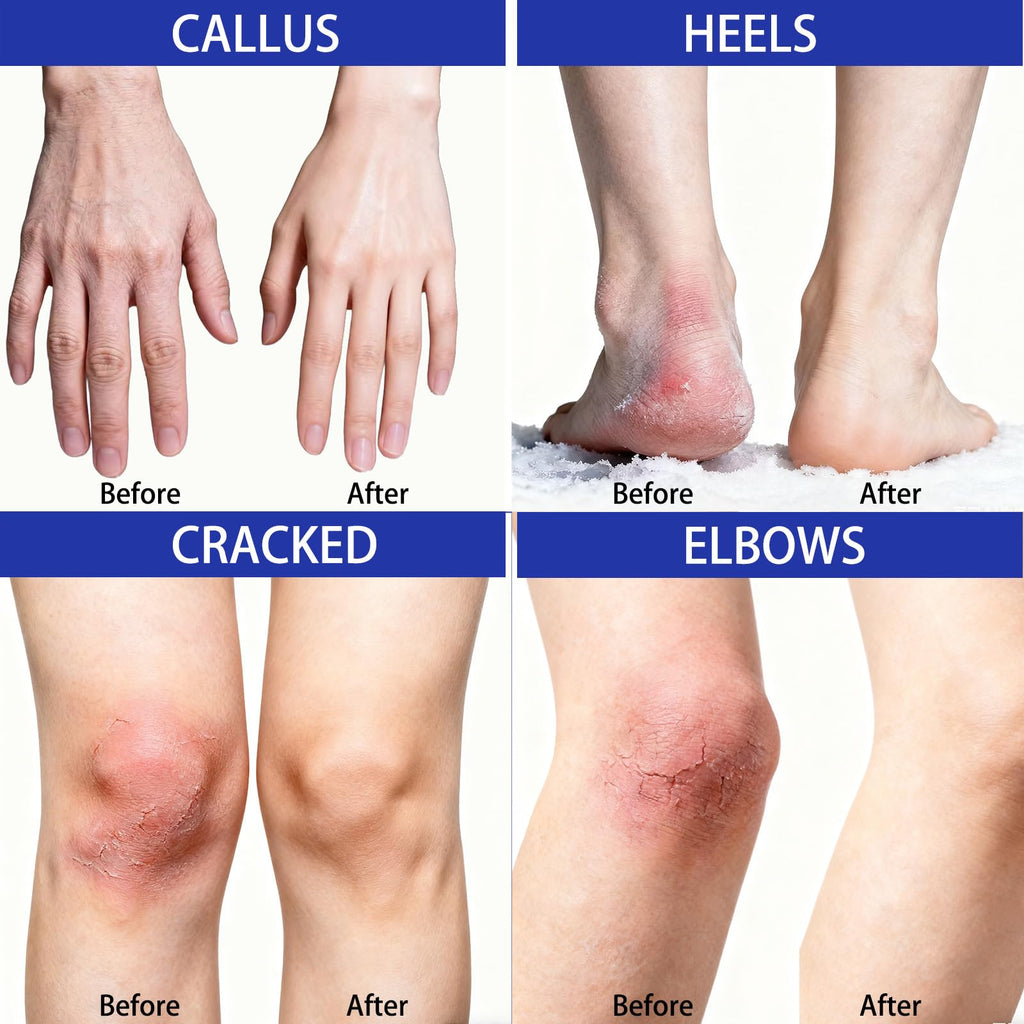 LOLX Urea Cream 40% + Salicylic Acid 2% – Deep Hydration for Feet and Dry Skin (5.29 oz)
