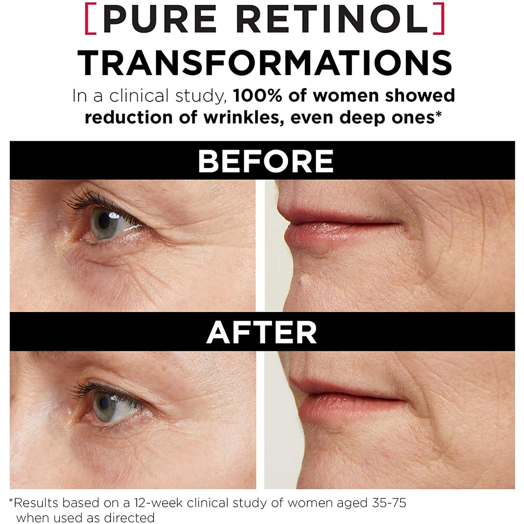 L'Oreal Paris Revitalift Triple Power LZR Retinol Night Serum — 0.3% Pure Retinol, Hydrating & Anti-Wine Texture Support, All Skin Types, 30ml