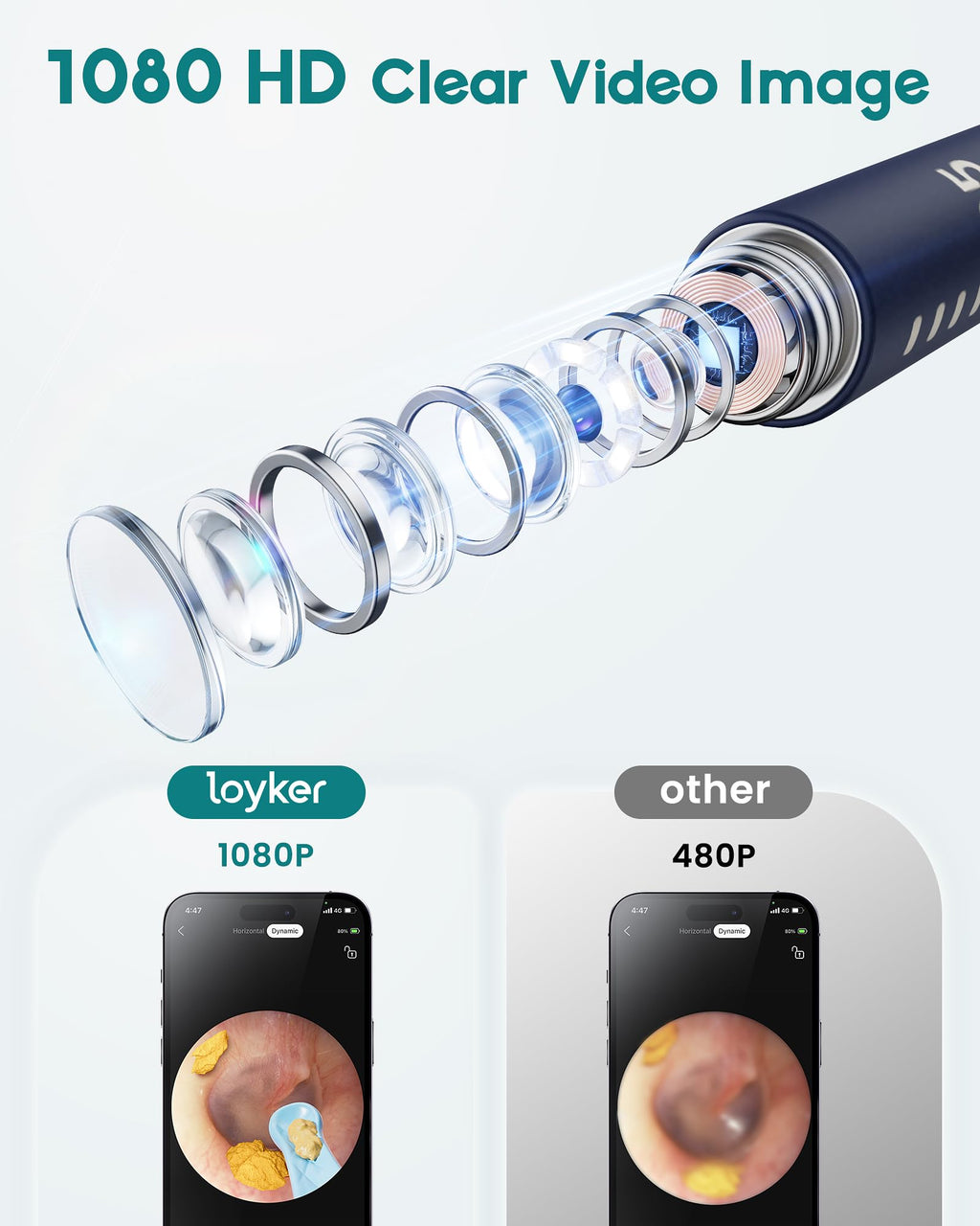 Loyker Ear Wax Removal Kit with 1080P Camera – Visual Ear Cleaner (12 Tips)