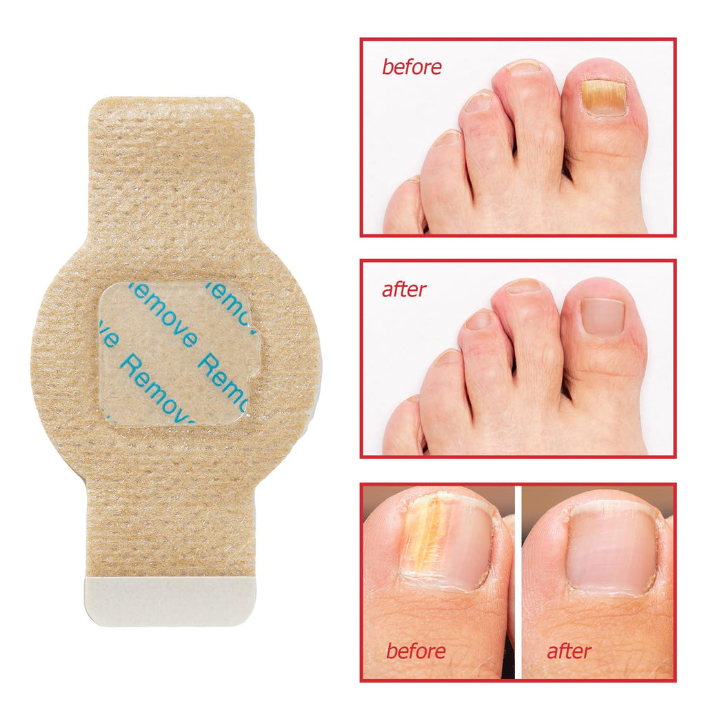 LTQXGT Fungal Nail Patches 2Pack – Extra Strength Toenail Repair