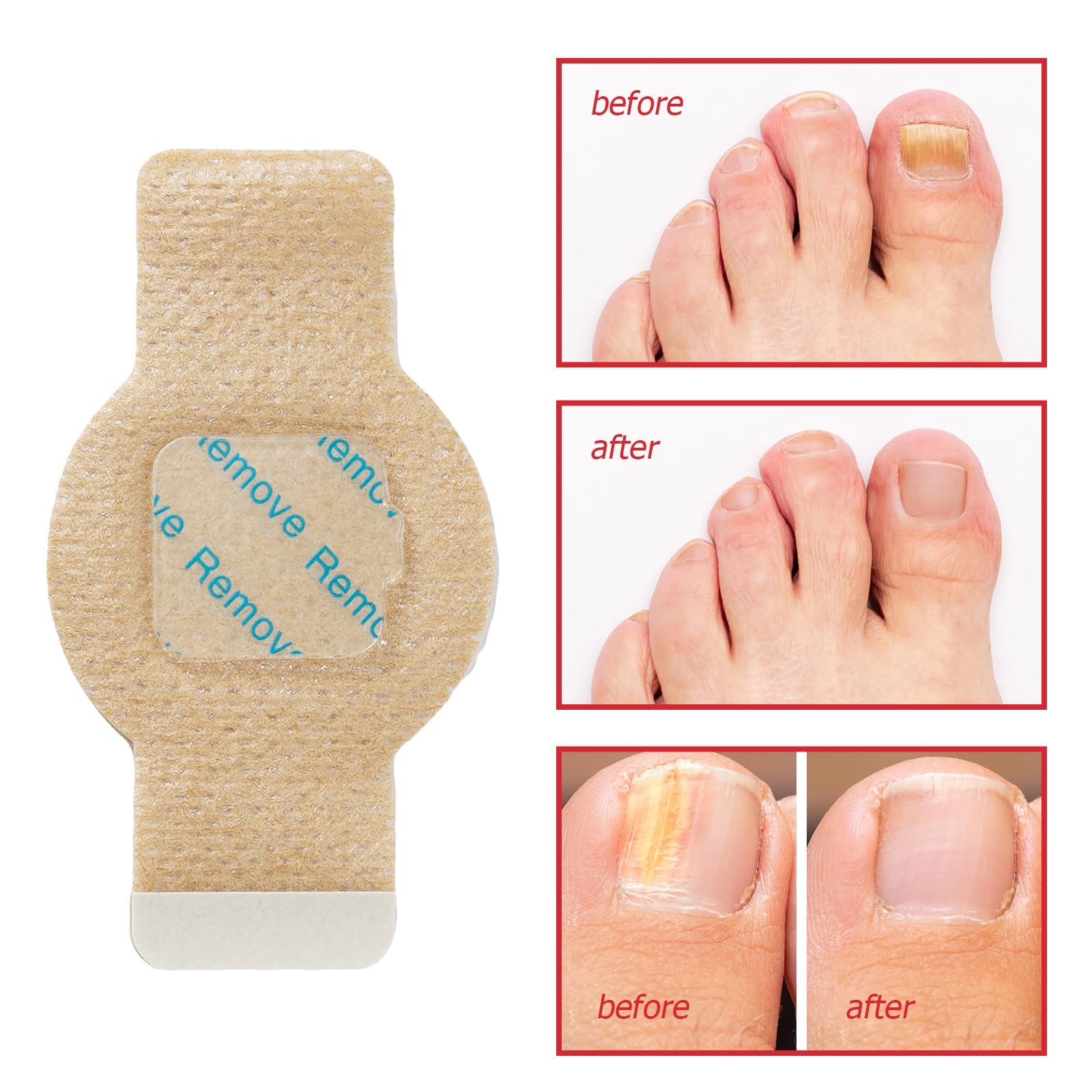 LTQXGT Fungal Nail Patches 2Pack – Extra Strength Toenail Repair