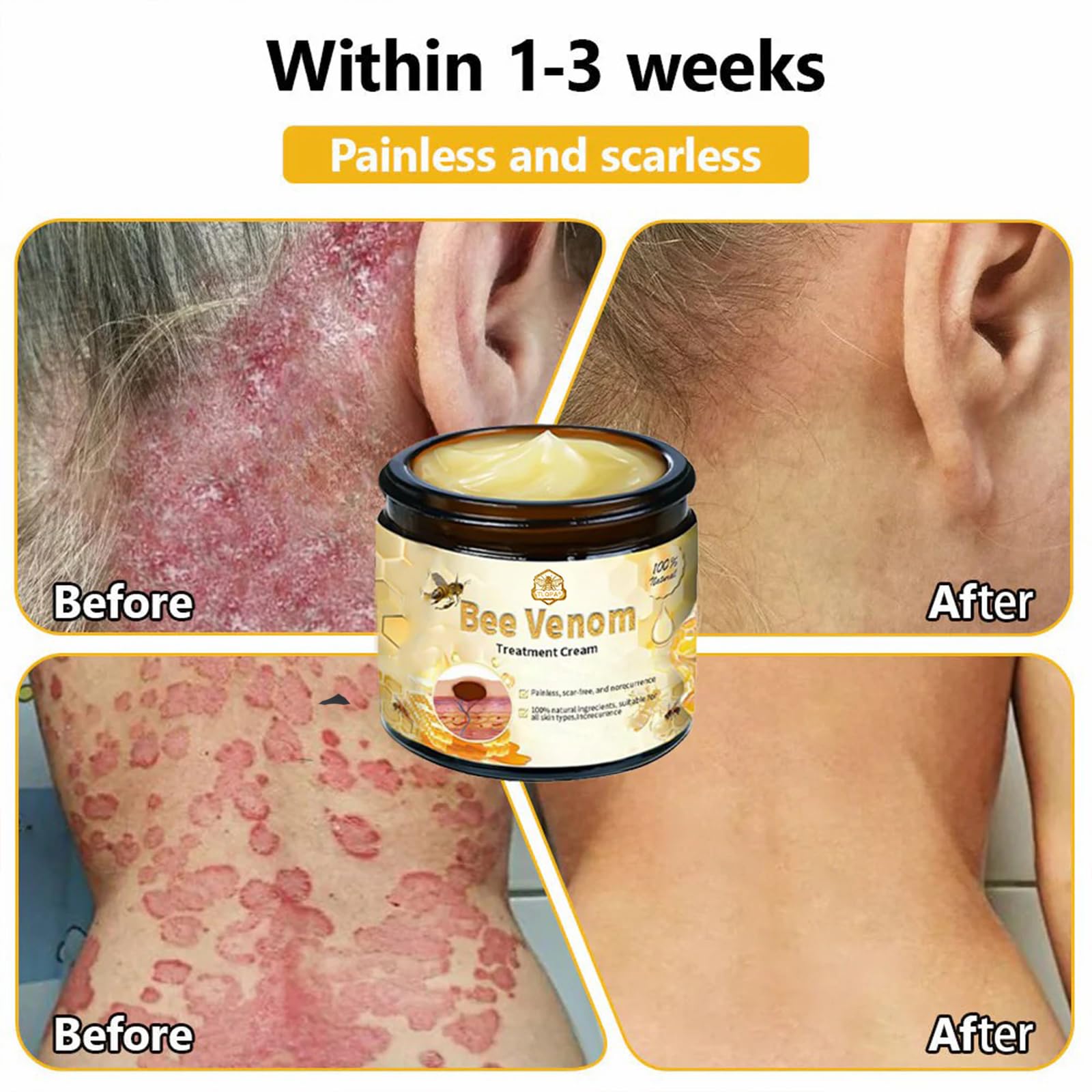 Luhaka Bee Venom Skin Cream – Deep Moisturizing Treatment for Blemish-Prone Skin
