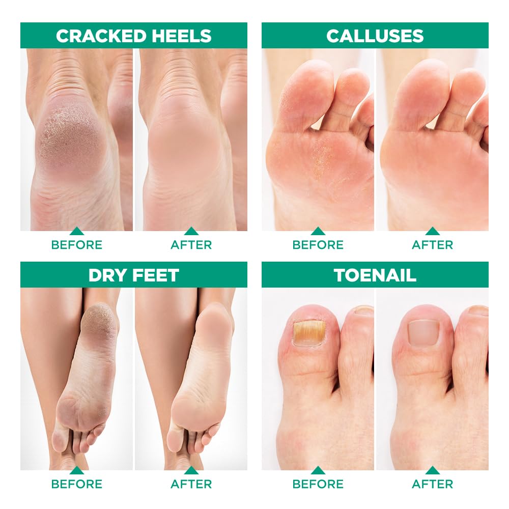 LV LAVINSO Tea Tree Oil Foot Soak with Epsom Salt – Made in USA