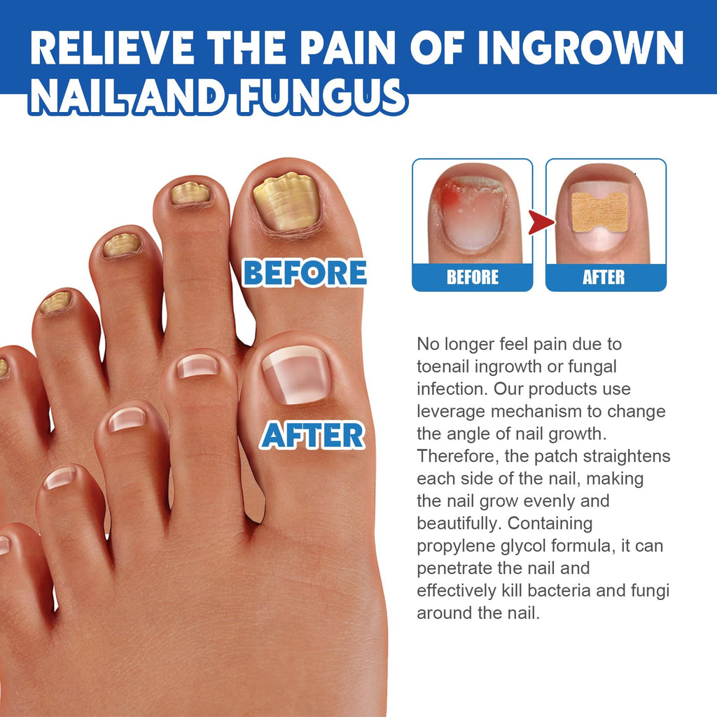 LYFXuGeMLM 20 Patches Fungal Nail Repair – Toenail Restoration, 8-Hour Intensive Treatment