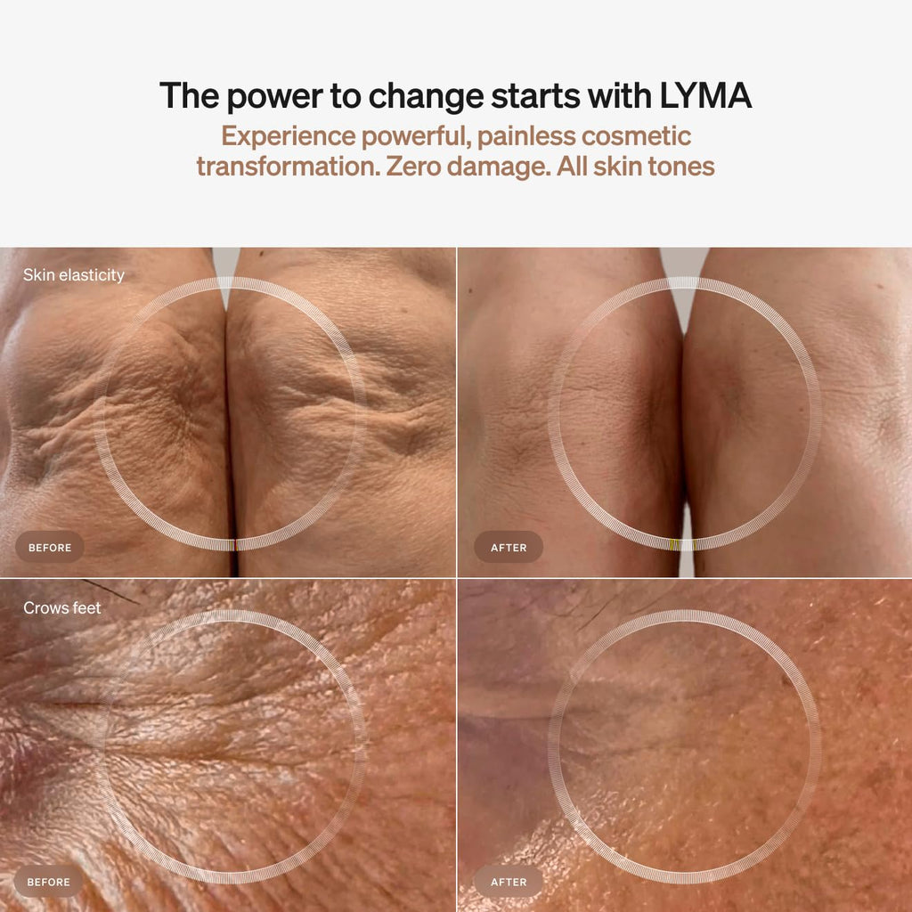 LYMA Laser Device – At-Home Clinic-Grade Near-Infrared Laser for Skin and Muscle Support
