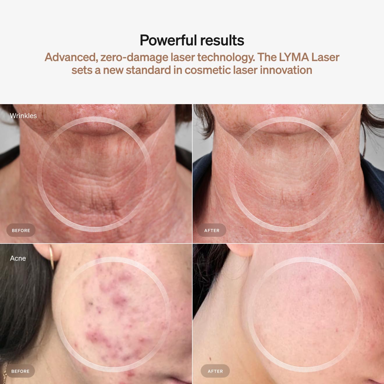 LYMA Laser Device – At-Home Clinic-Grade Near-Infrared Laser for Skin and Muscle Support