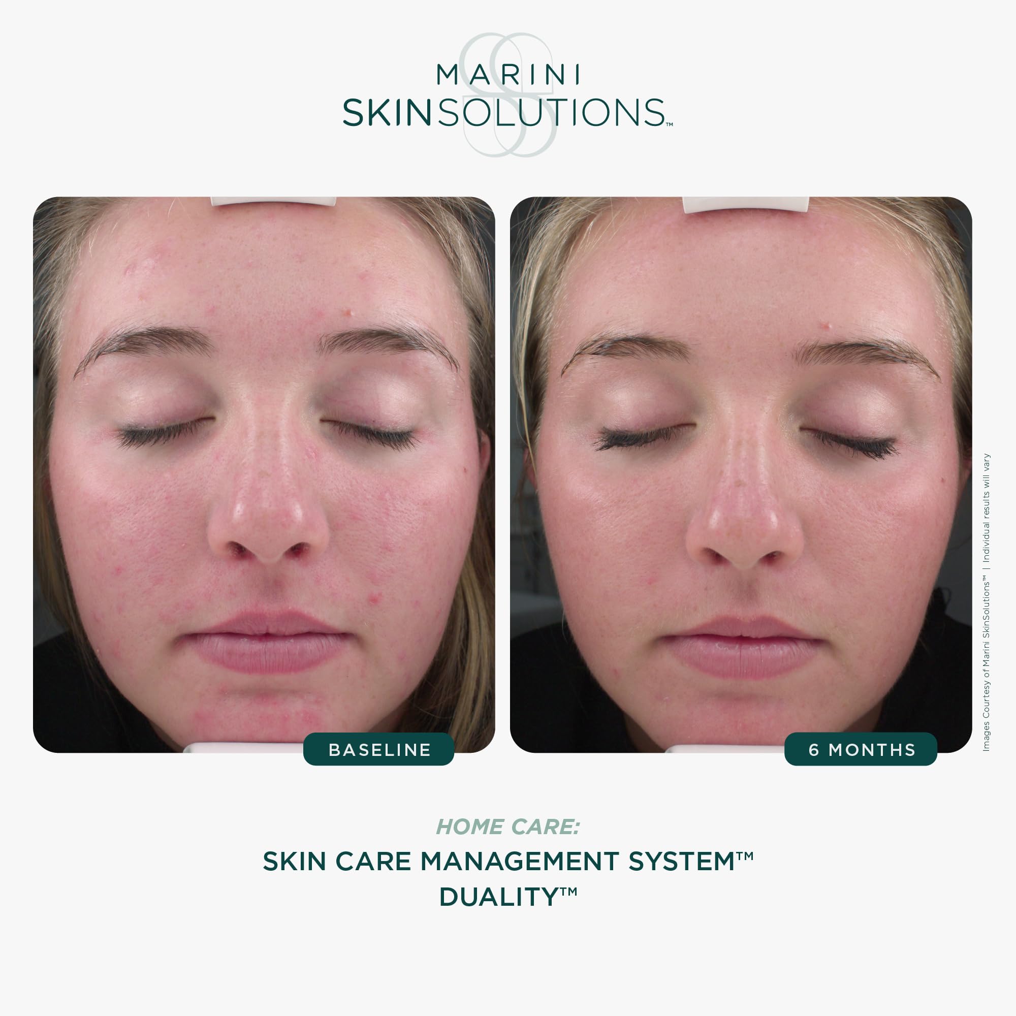 Marini SkinSolutions Duality: Benzoyl Peroxide 10% + Retinol Acne & Anti-Aging Cream