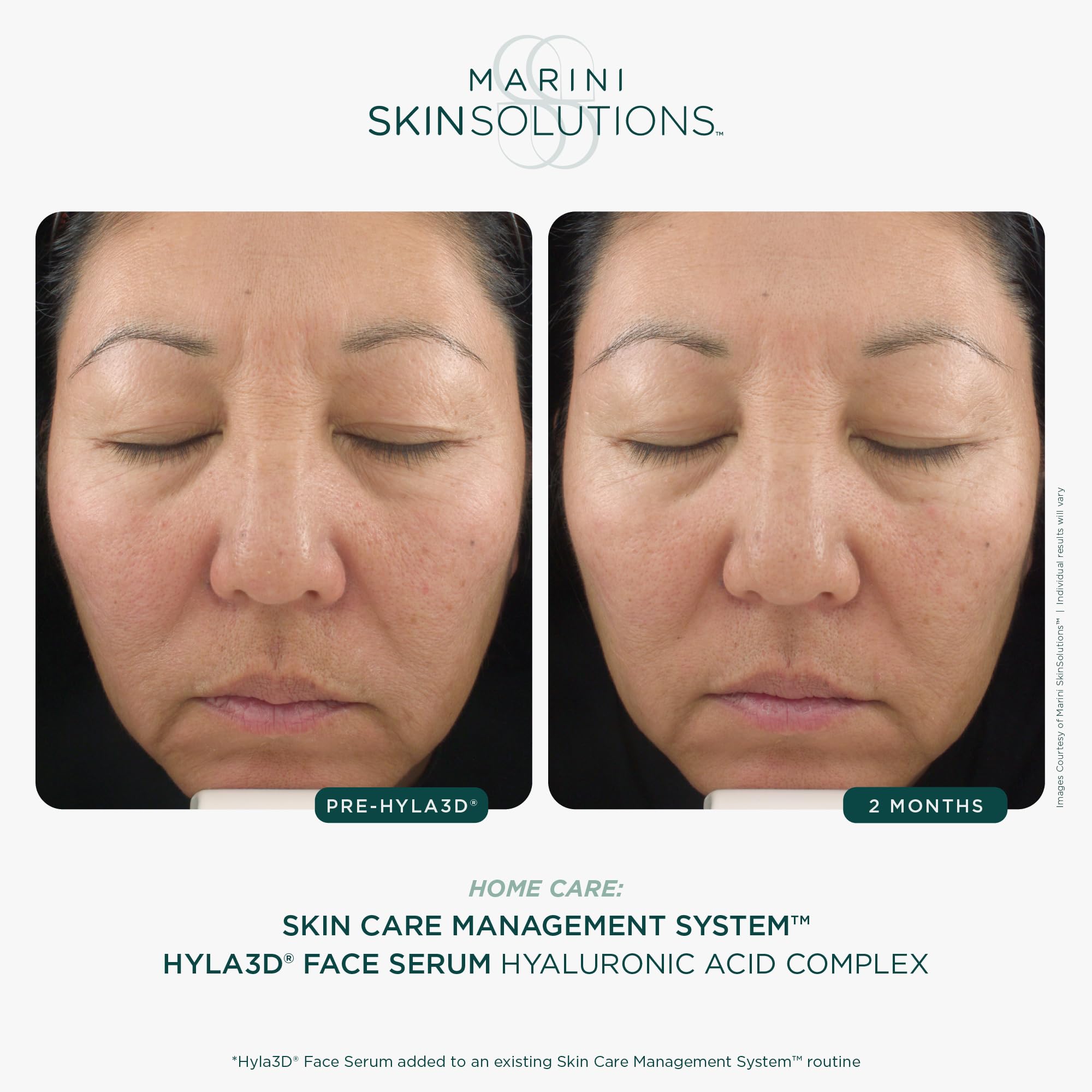 Marini SkinSolutions Hyla3D Face Serum – Patented HA Hydration for All Skin Types