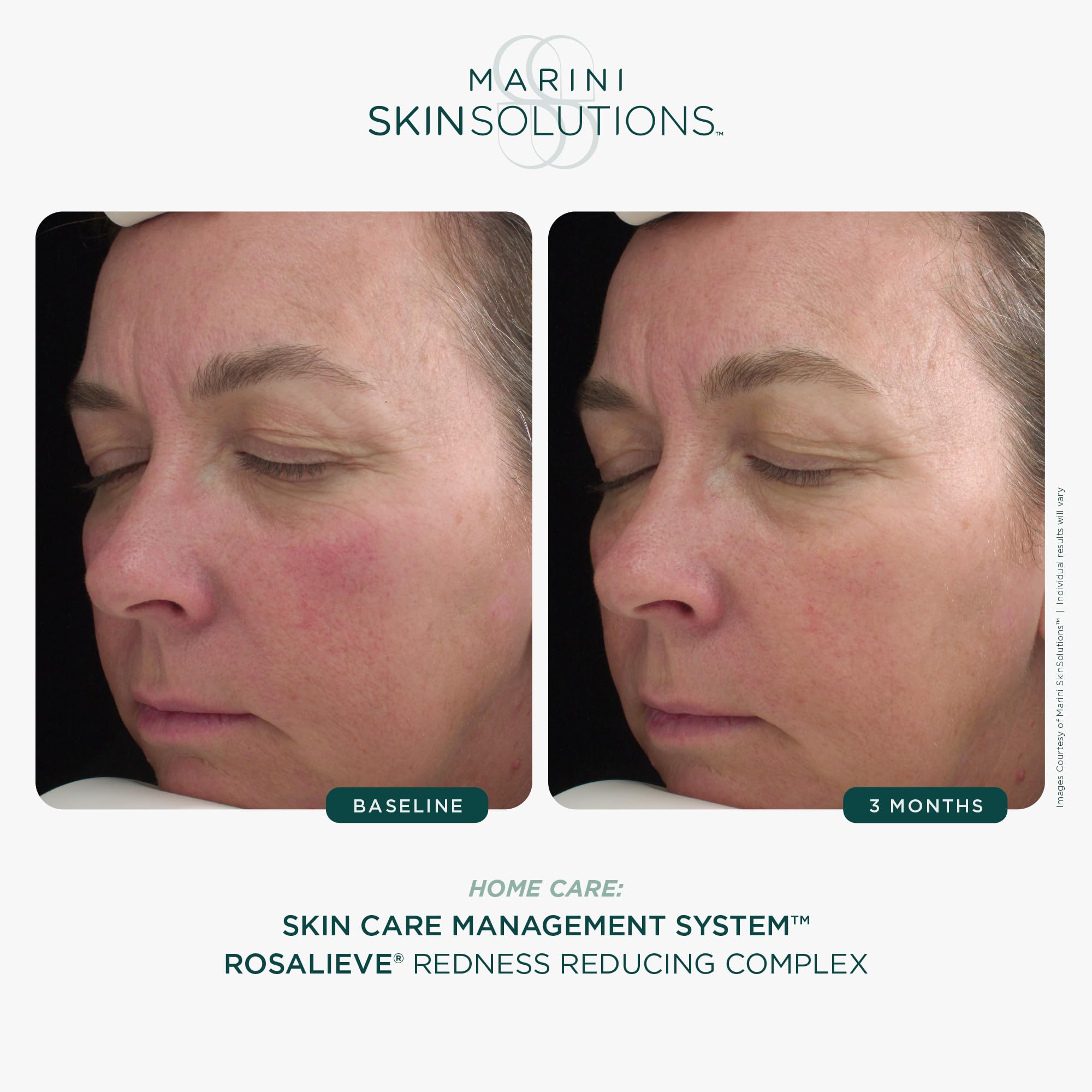 Marini RosaLieve - Redness Reducing Face Lotion with Azelaic Acid & Tetrapeptide-14