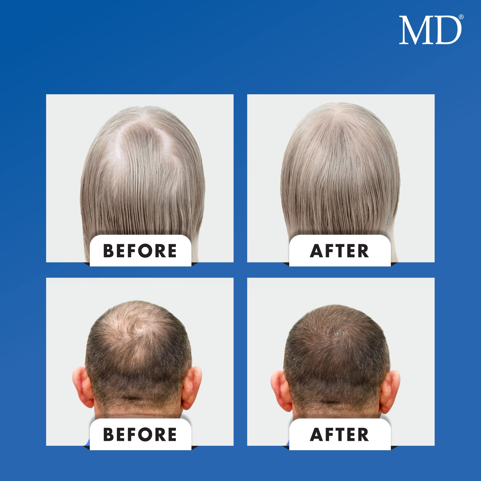 MD Nutri Hair Growth Supplement with Biotin (30 capsules) | Supports Fuller, Thicker-Looking Hair | Drug-Free Formula