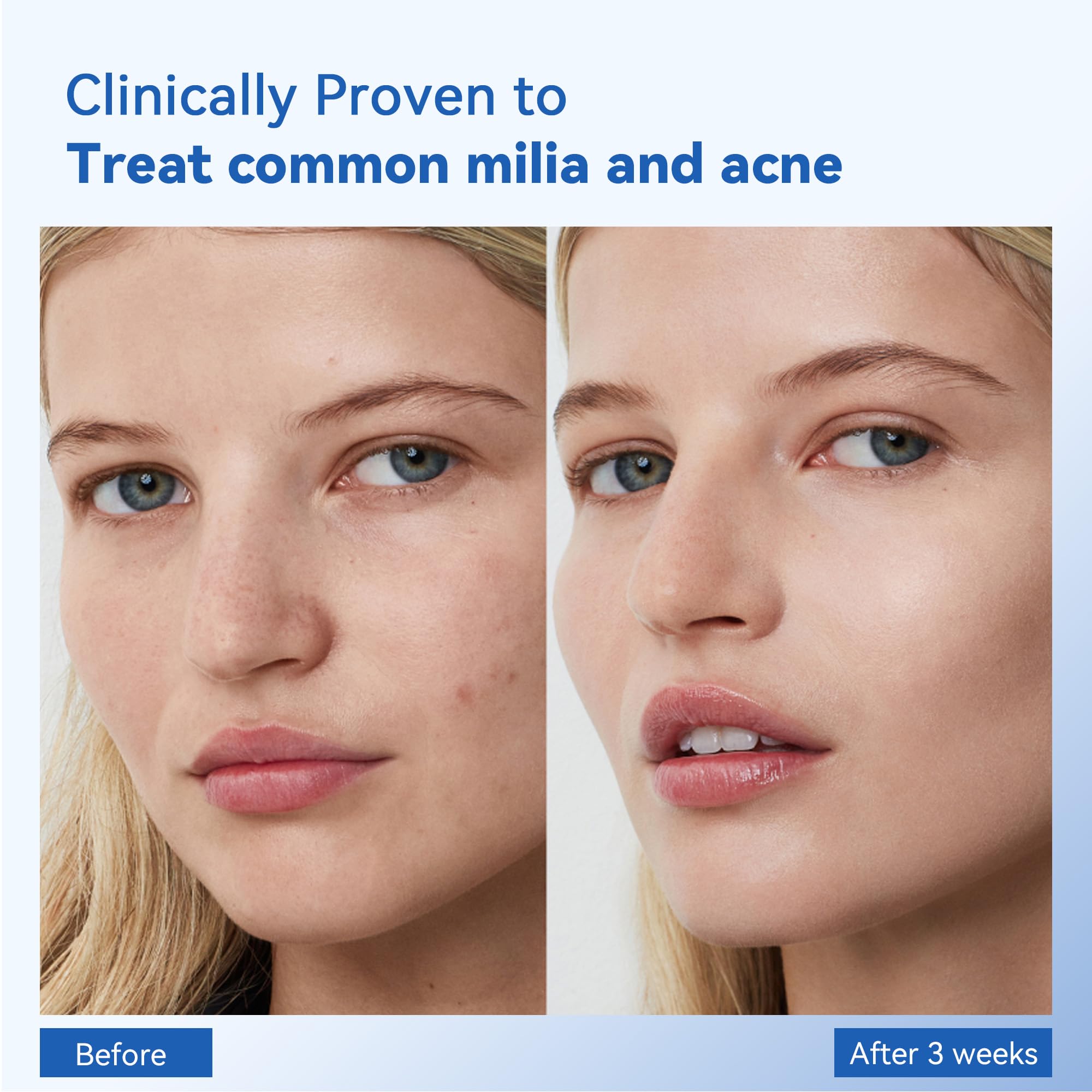 MEOLY Milia Remover with Salicylic Acid – Milia Spot Treatment for Eyes & Face | 30 ml