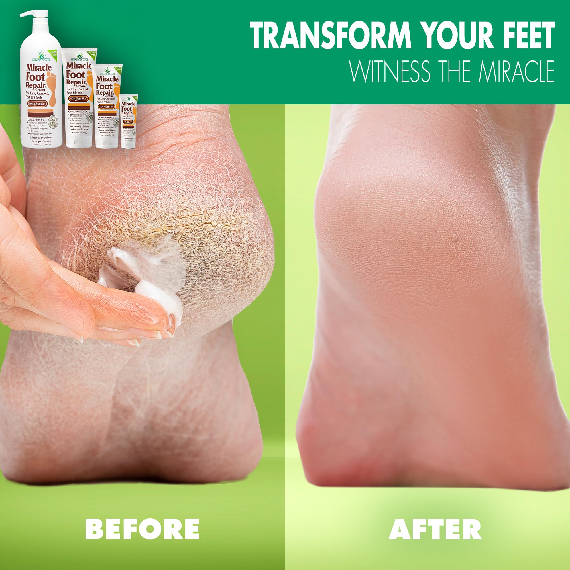 Miracle of Aloe Foot Repair Cream (32 oz) – 60% Ultra Aloe Moisturizes
