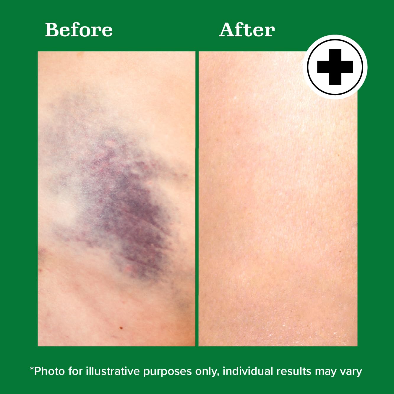 Miracle Plus Arnica Bruise Gel – Extra Strength Vitamin K, 2-Pack