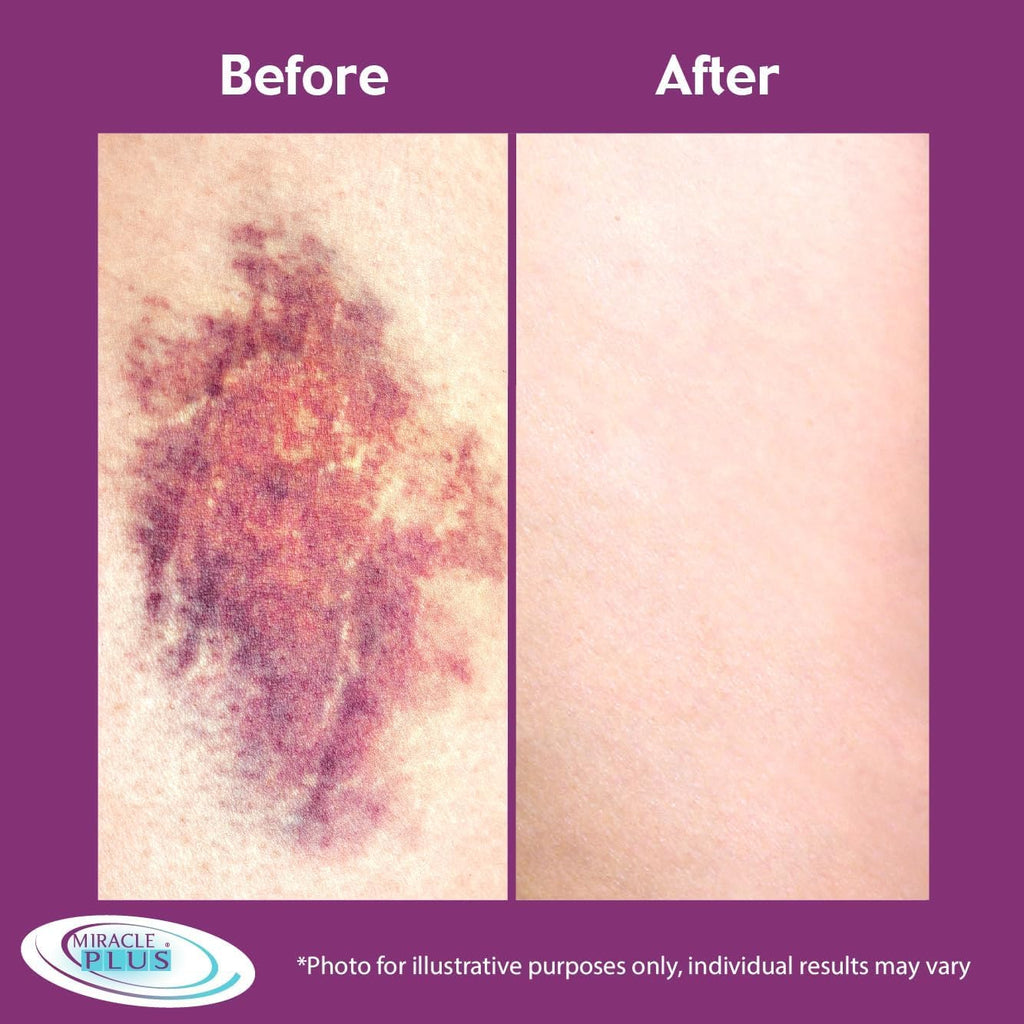 Miracle Plus Arnica Cream & Gel – Bruising Relief 2pc Set with Vitamin K & Horse Chestnut