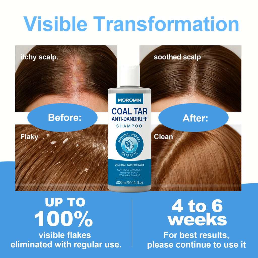 Morovan Coal Tar Shampoo 2%: Severe Dandruff & Itchy Scalp