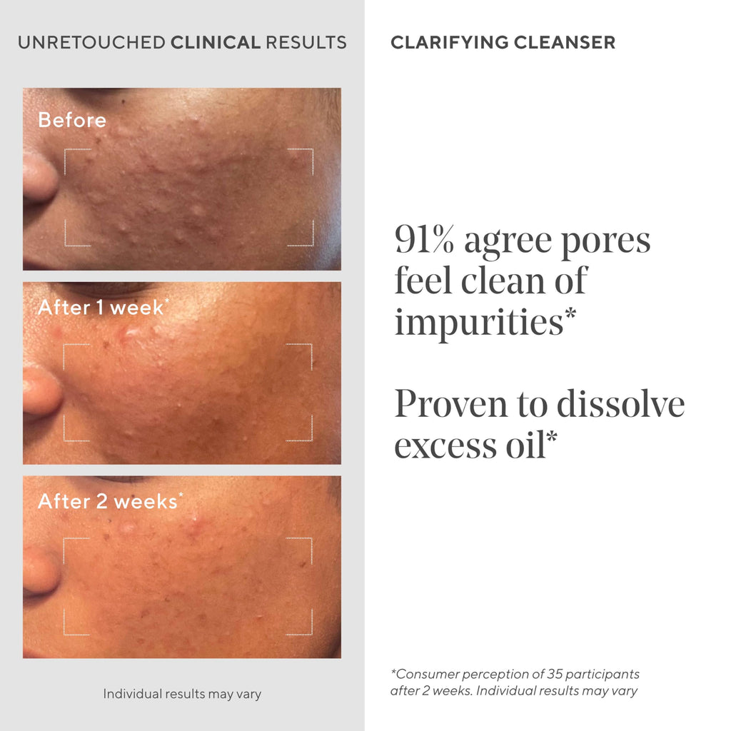 Murad Acne Control Clarifying Cleanser – Salicylic Acid & Green Tea for Oil Control (5 oz)