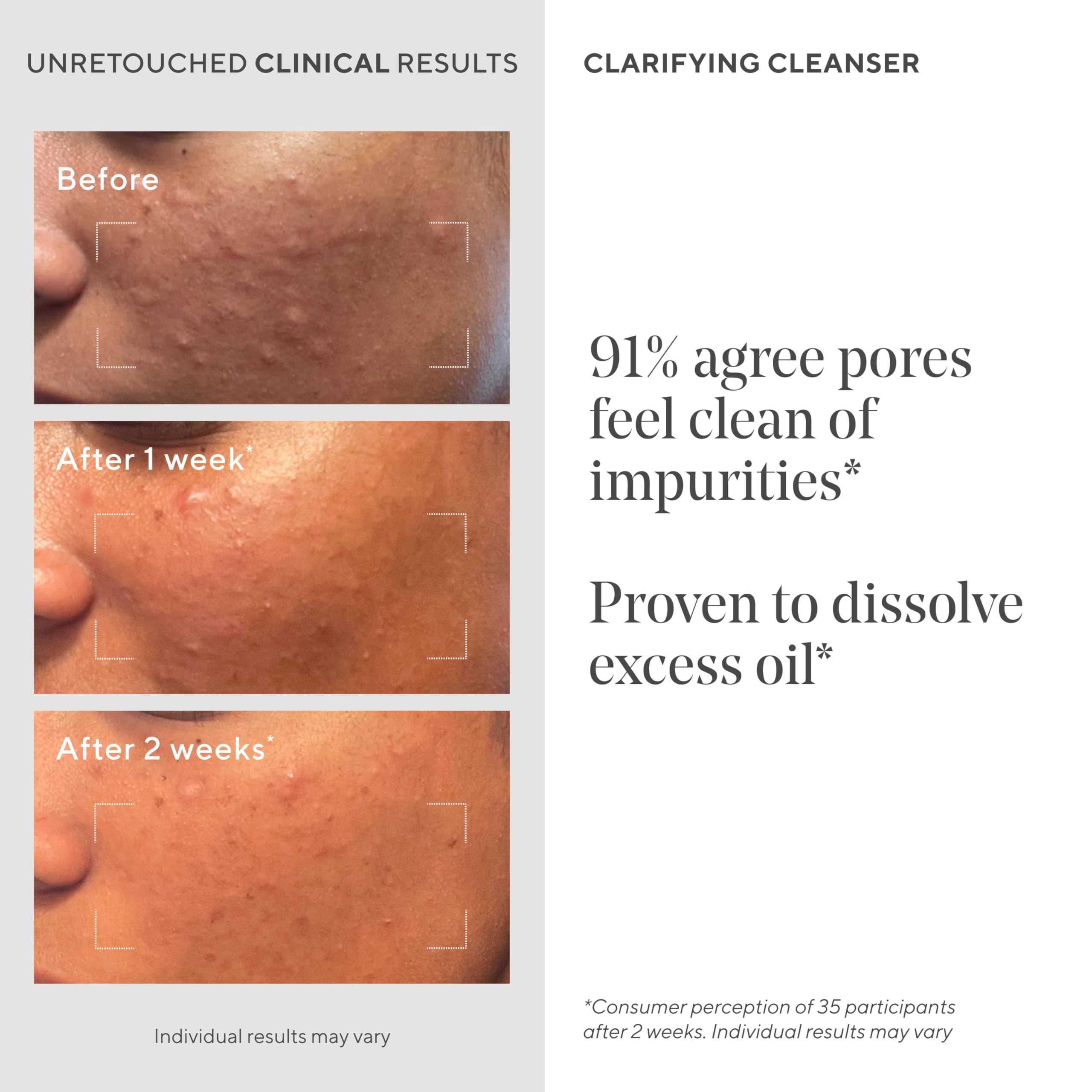 Murad Acne Control Clarifying Cleanser – Salicylic Acid & Green Tea for Oil Control (5 oz)