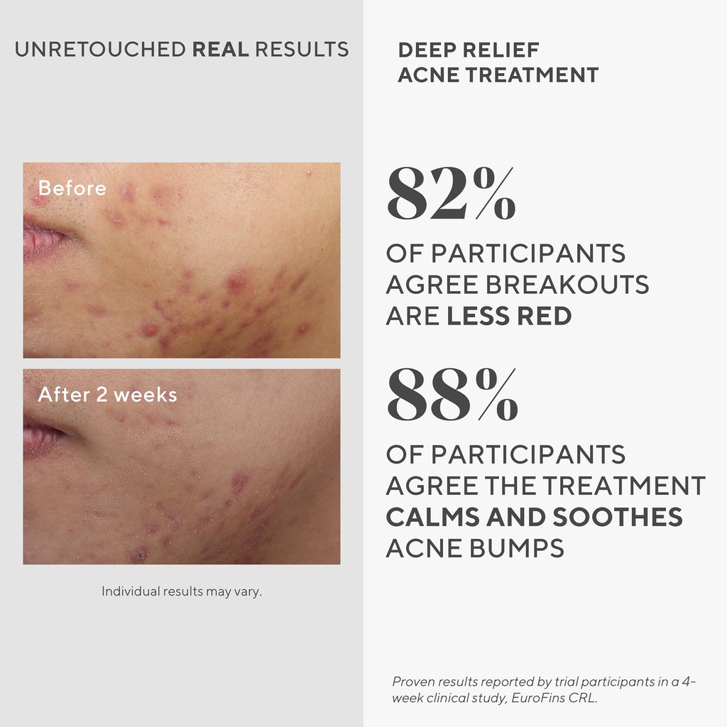 Murad Deep Relief Acne Treatment – 2% Salicylic Acid Spot Serum for Deep Breakouts