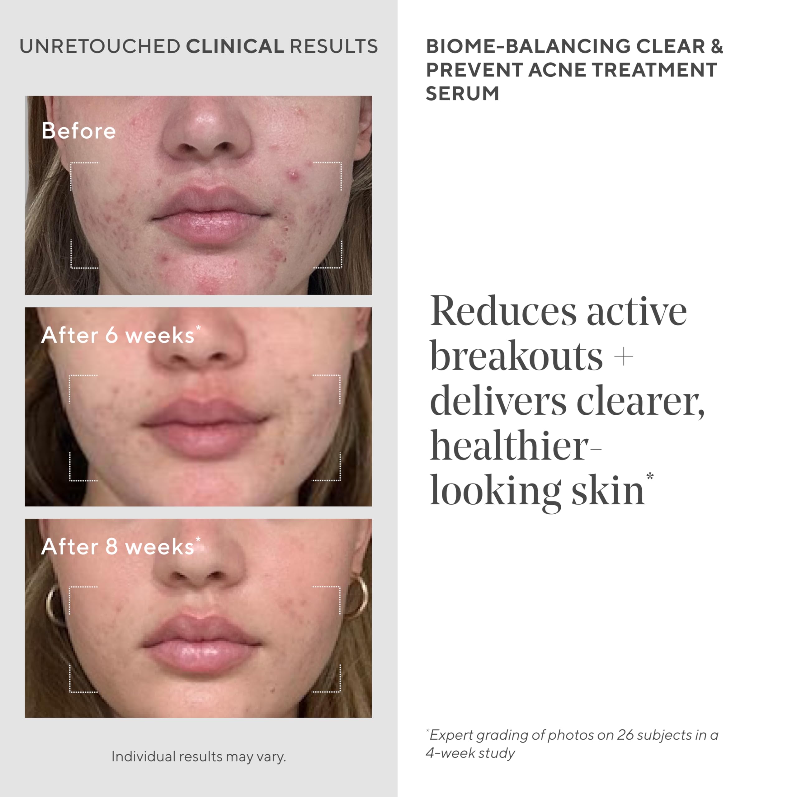 Murad Biome-Balancing Acne Treatment Serum – Salicylic, Mandelic & Glutamic Acids | 1.0 fl oz